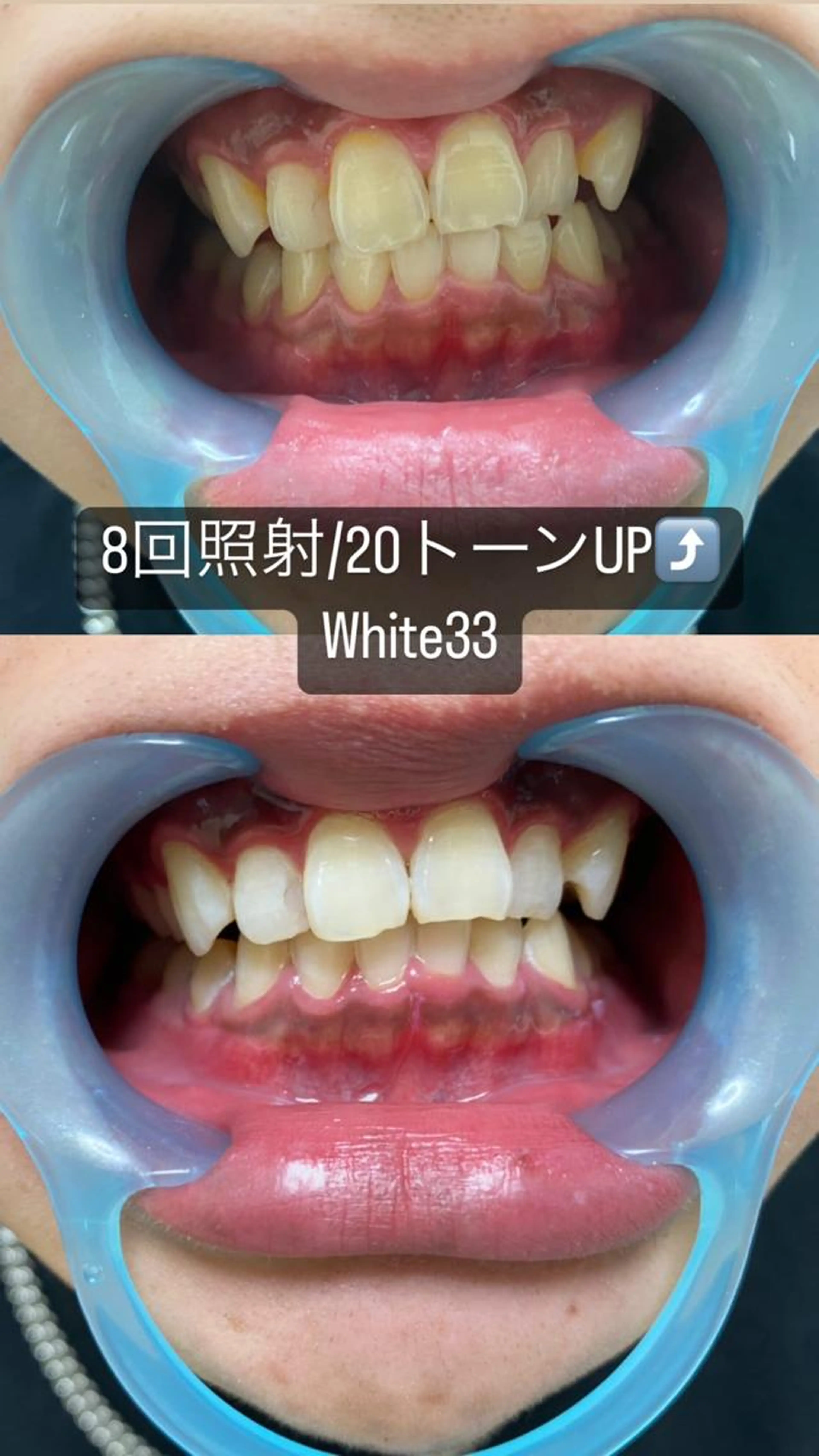 【学割】¥5980→1980 ホワイトニング15分×2セットの写真