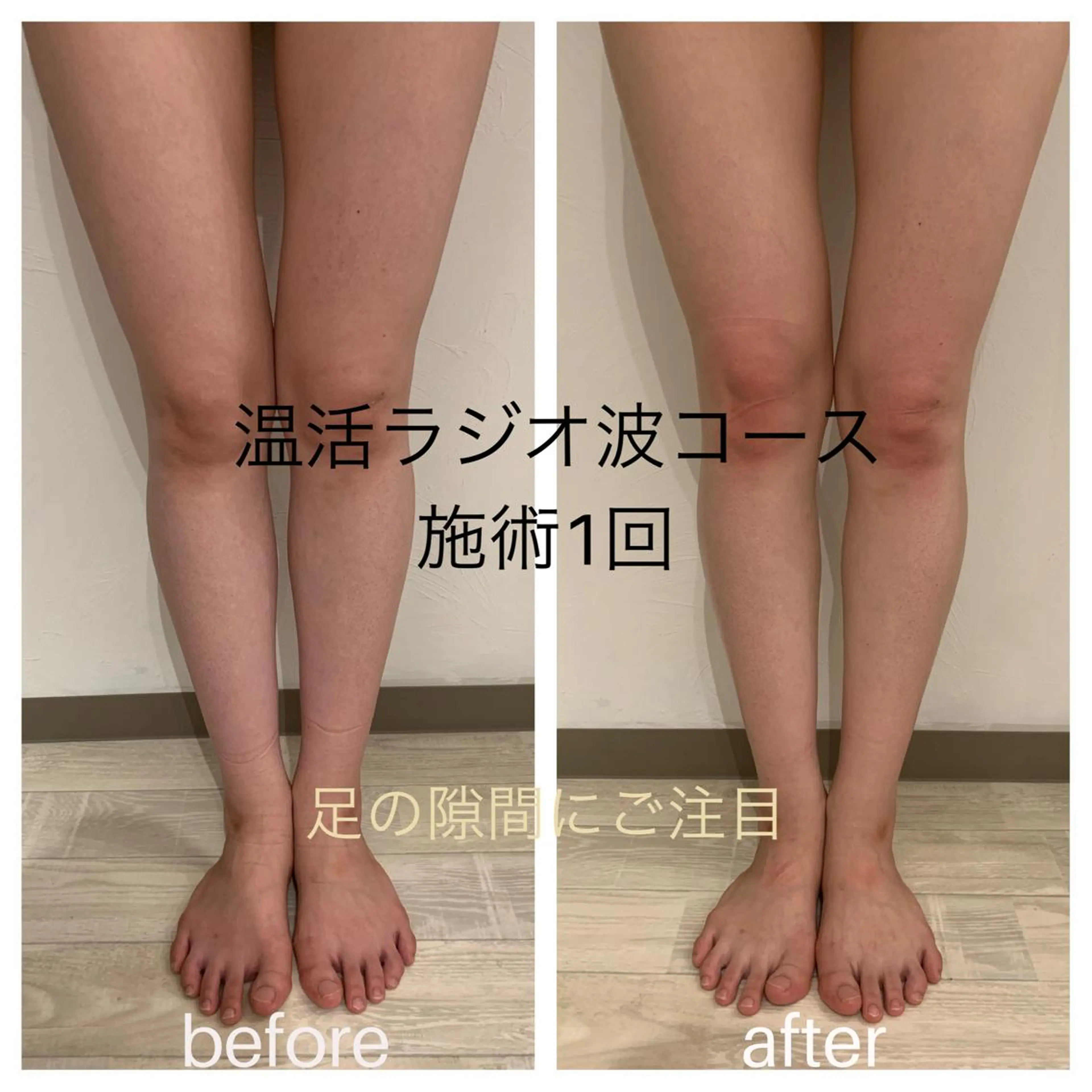 《今月のみの価格❗️》脚セルライトに🤭お試しラジオ波リンパマッサージ痩身で目指せ美脚🧡むくみすっきりで大好評！の写真