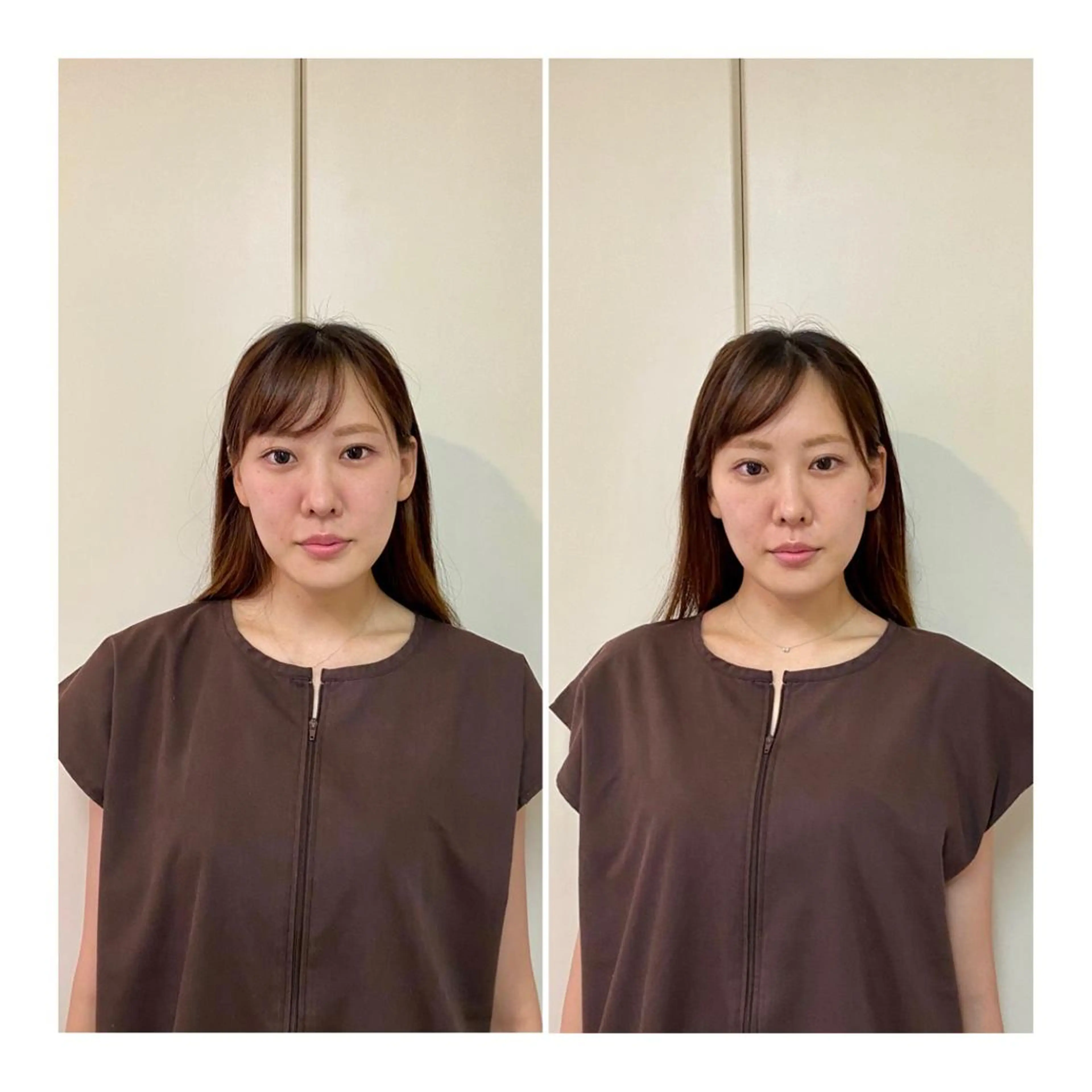 その他 即小顔♥️美容鍼× ハーブピーリングのその他イメージ