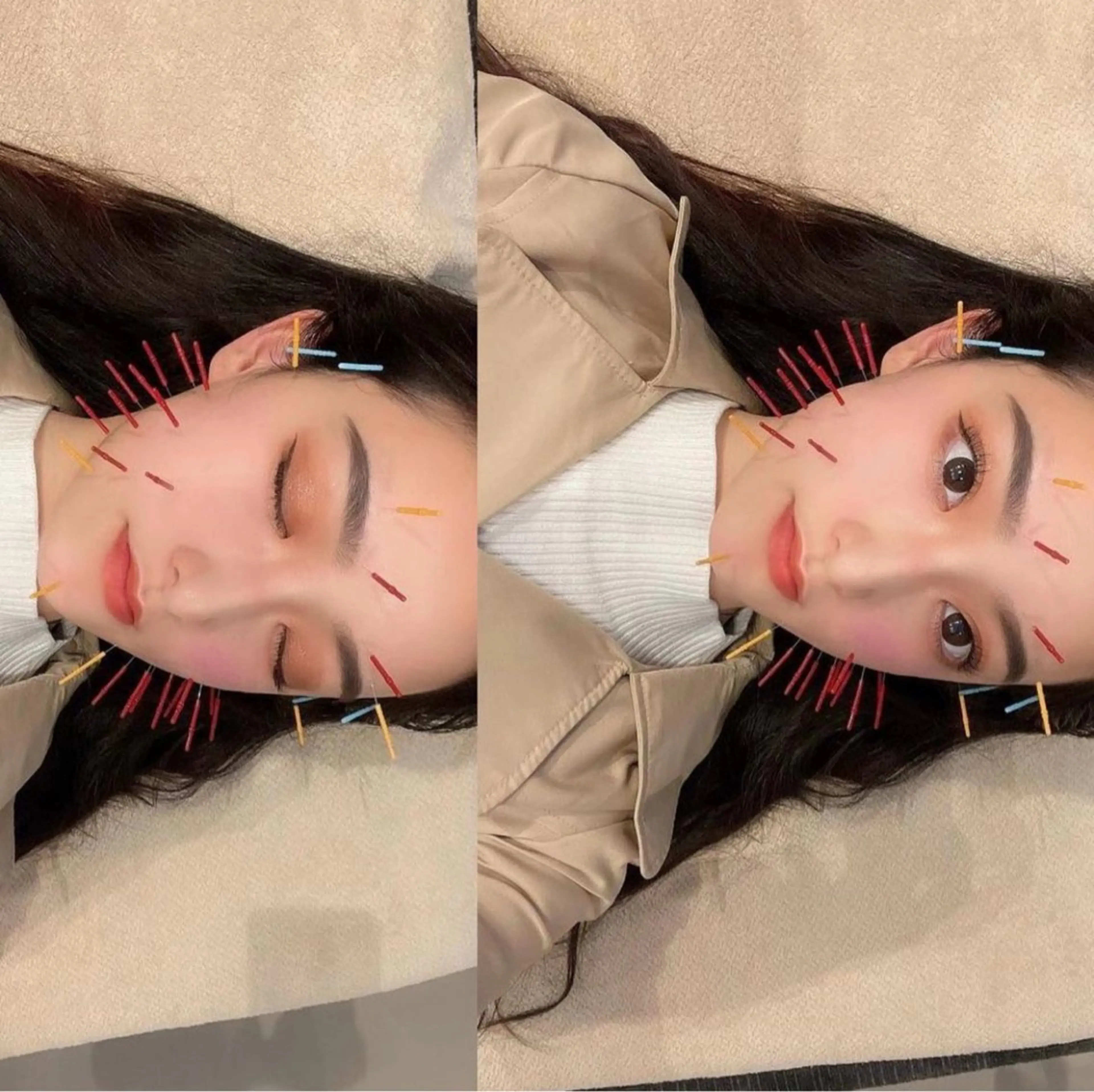 【むくみ・エラ改善】オリジナル美容鍼の写真