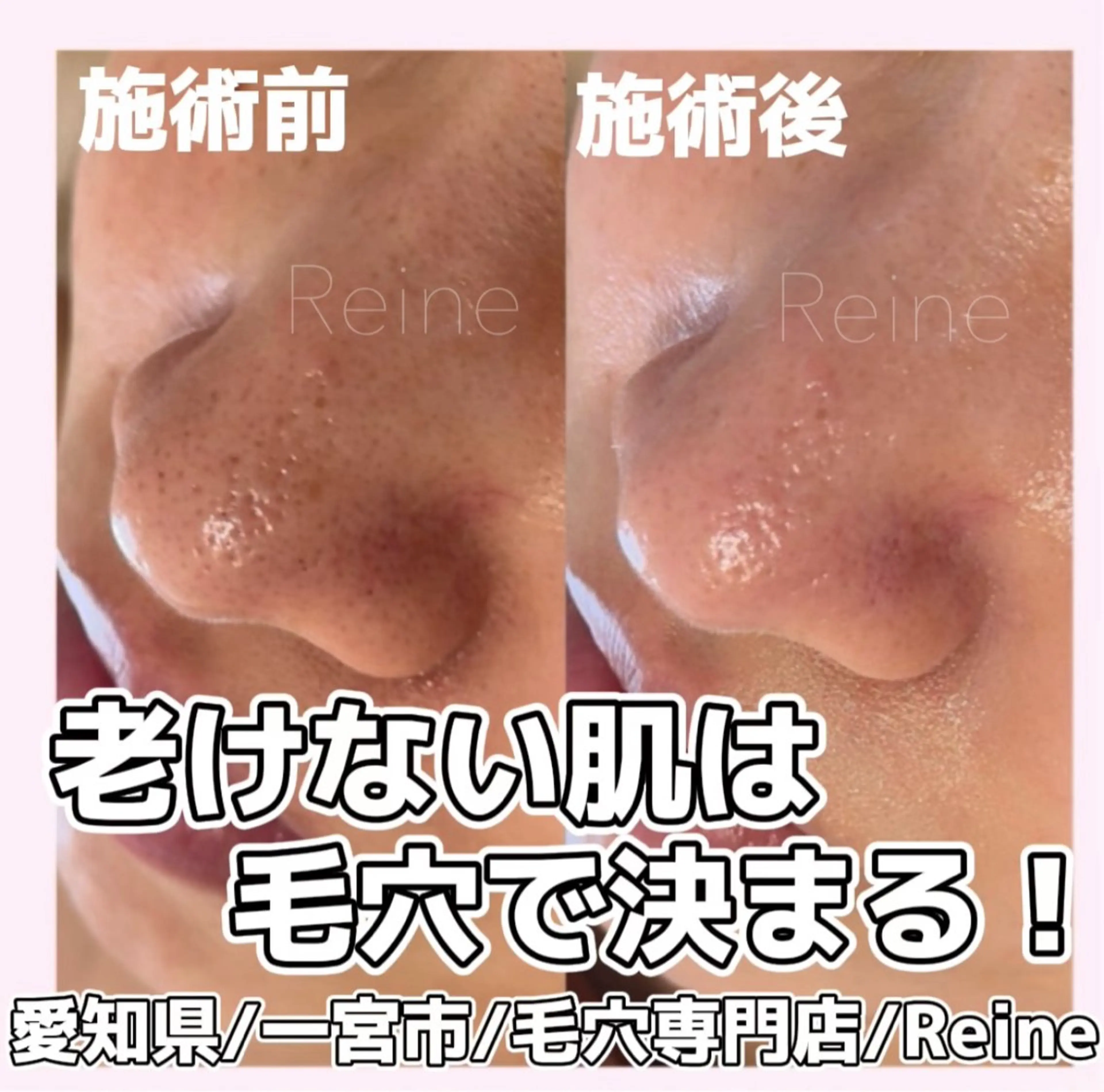 エステ Reine BeautySalon所属・毛穴/シミ肝斑/脱毛 横山梨里のエステ・リラクイメージ