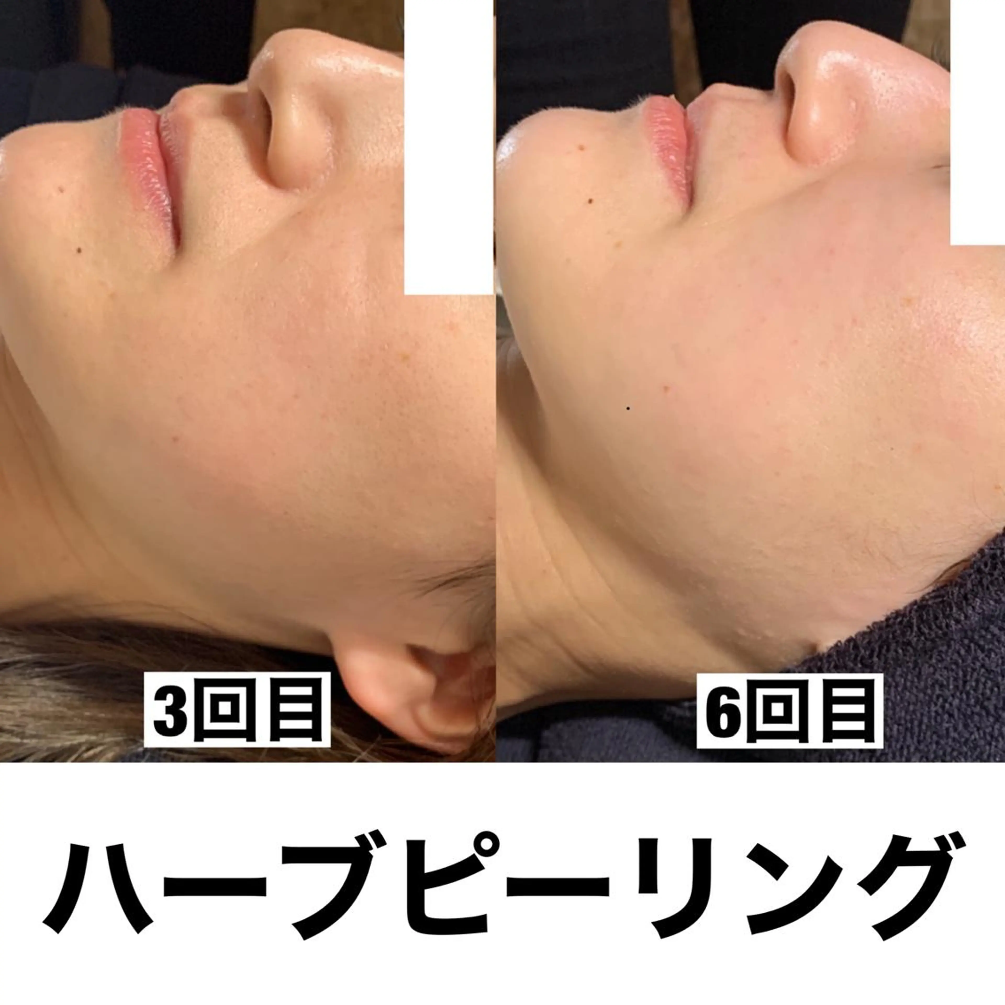 メンズ エステ リラク 姫路ハーブピーリング・韓国肌管理専門店Emotional所属・Yuka .のエステ・リラクイメージ