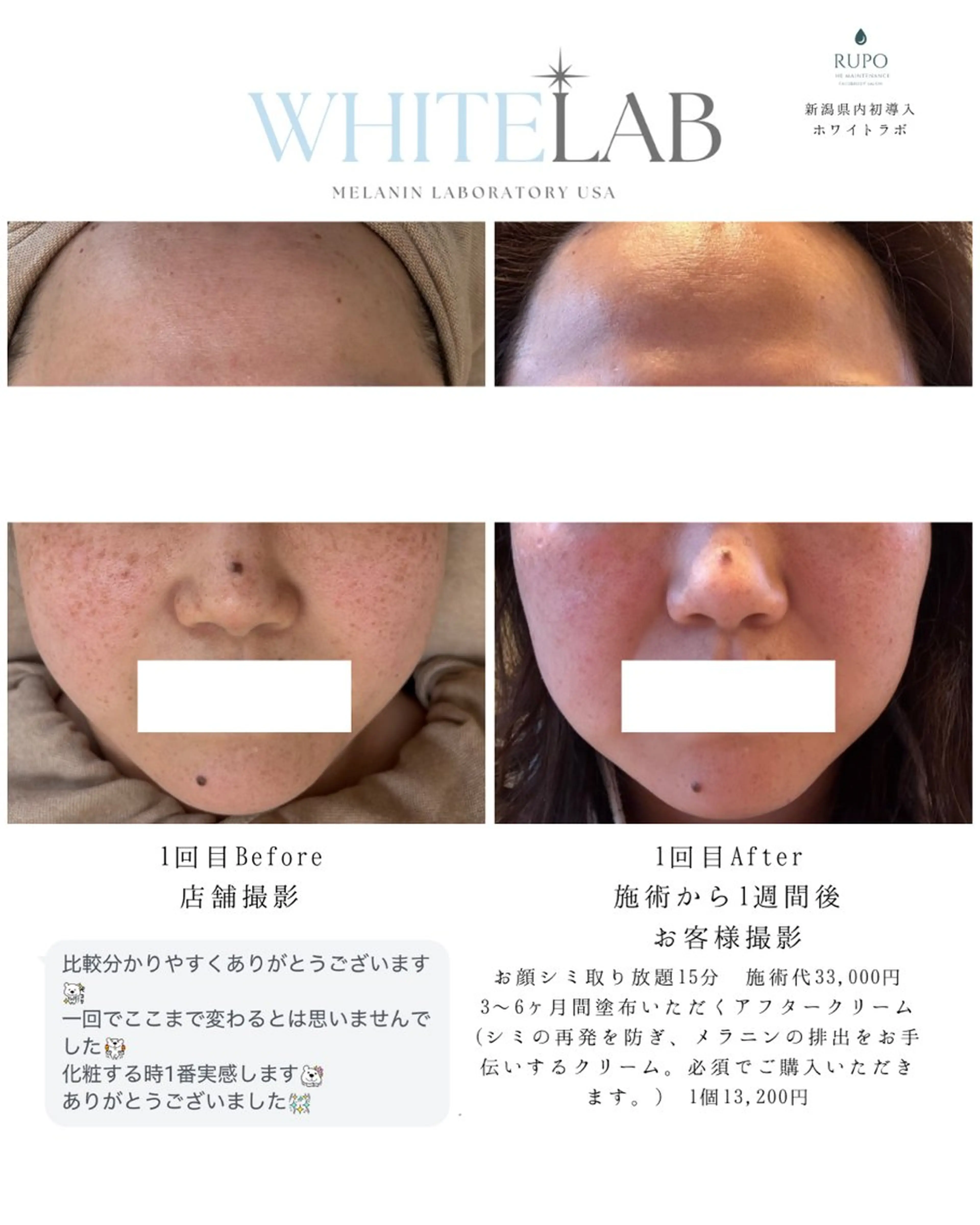 新潟県内初導入7日でシミ取りホワイトラボ11,000〜の写真