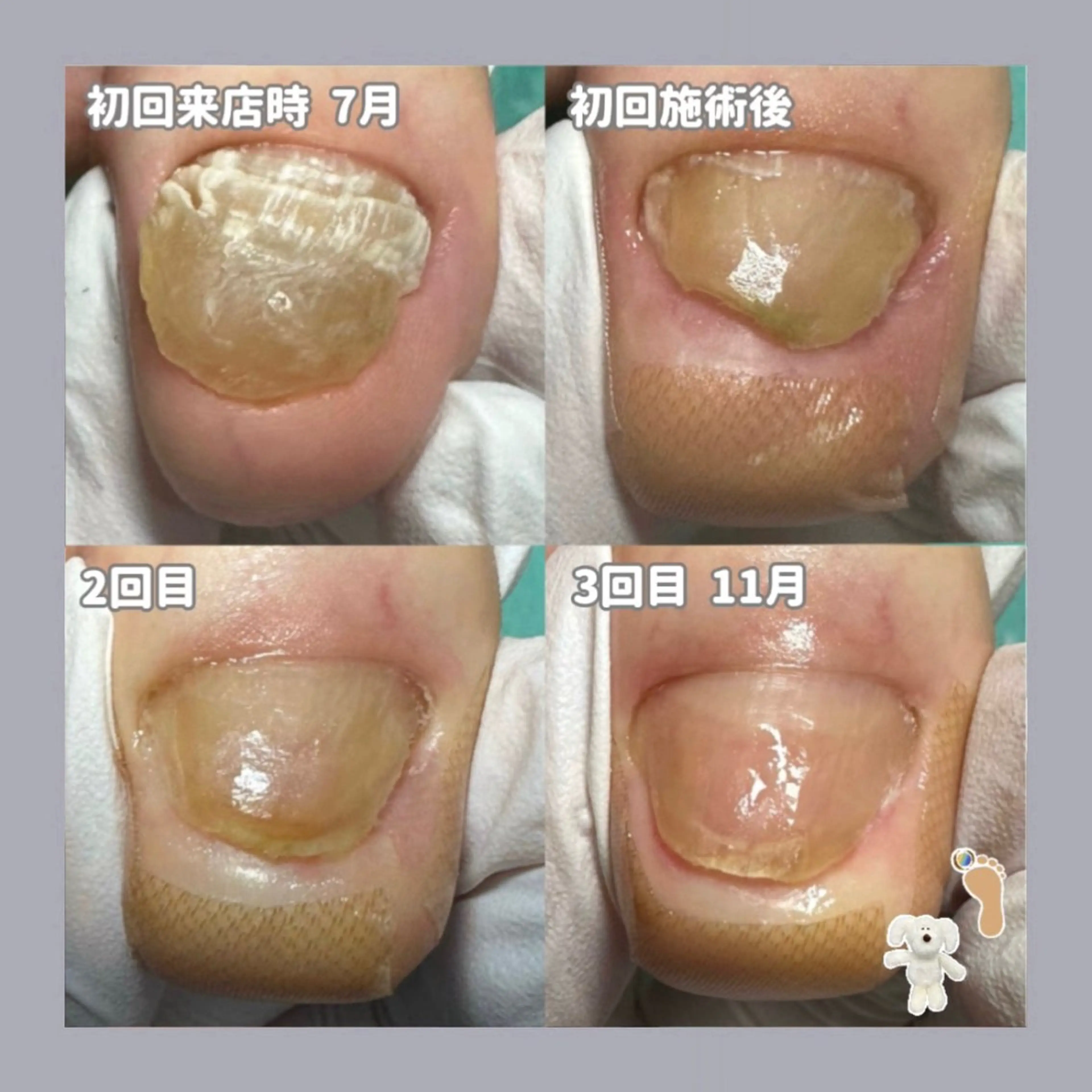 ミニモ限定価格‼️【分厚い爪再生補正２趾】思わず隠したくなる爪…諦めないで下さい💡正常な爪へ再生致しますの写真