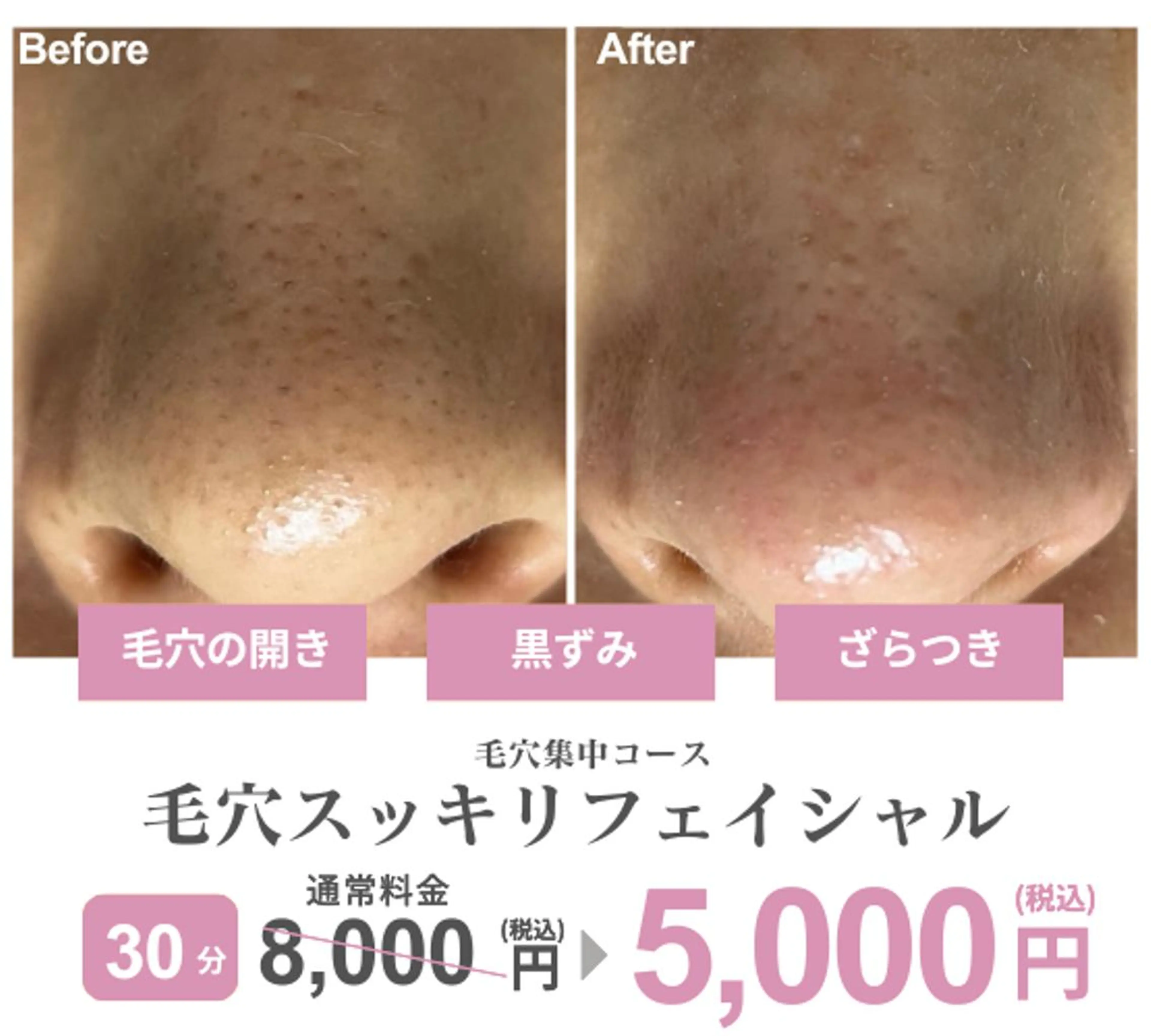 [12月限定]毛穴スッキリフェイシャル（30分コース）の写真