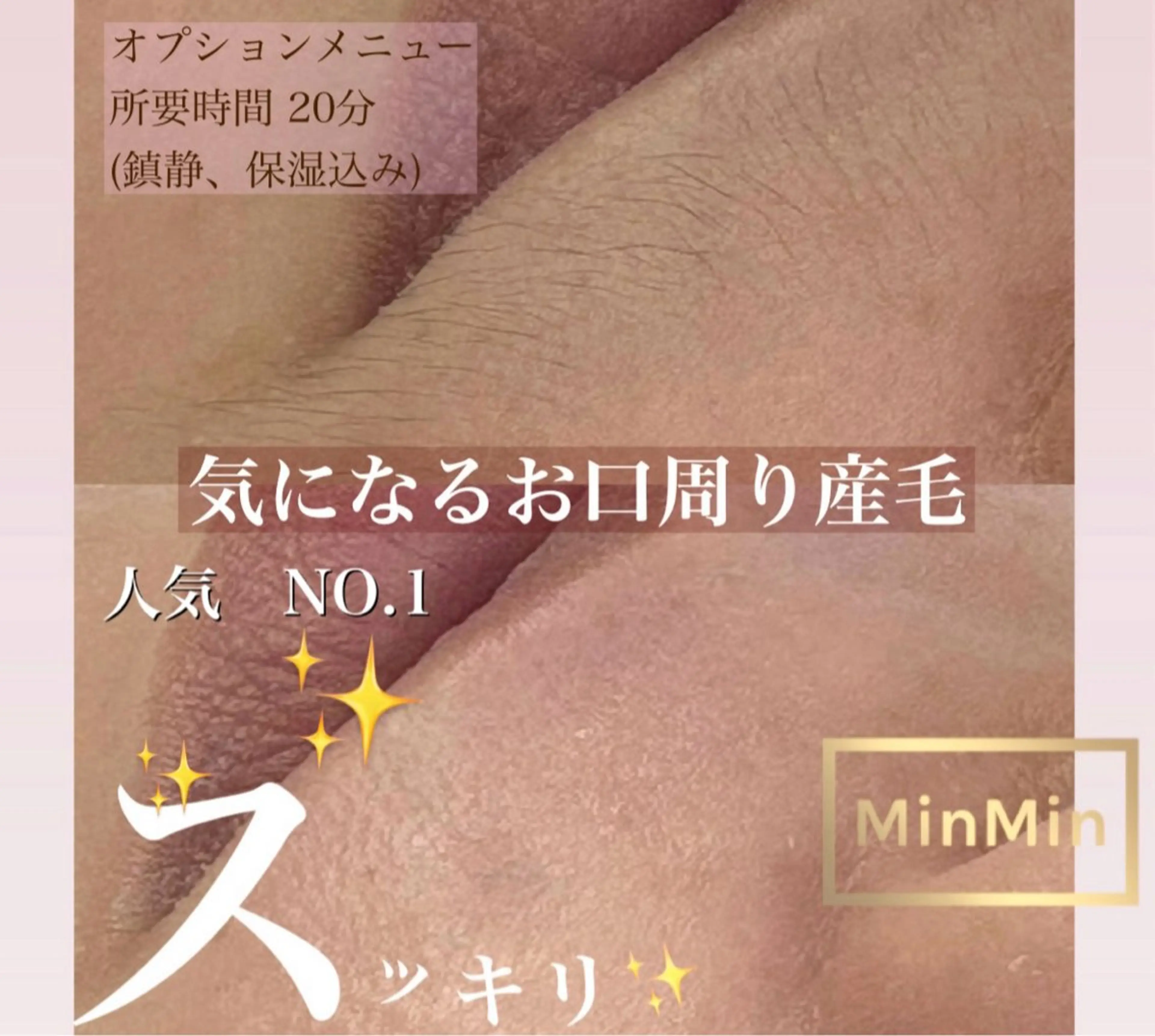 【施術モデル・ビフォーアフター撮影可の方限定】眉毛ワックス脱毛＋口ひげワックス脱毛の写真