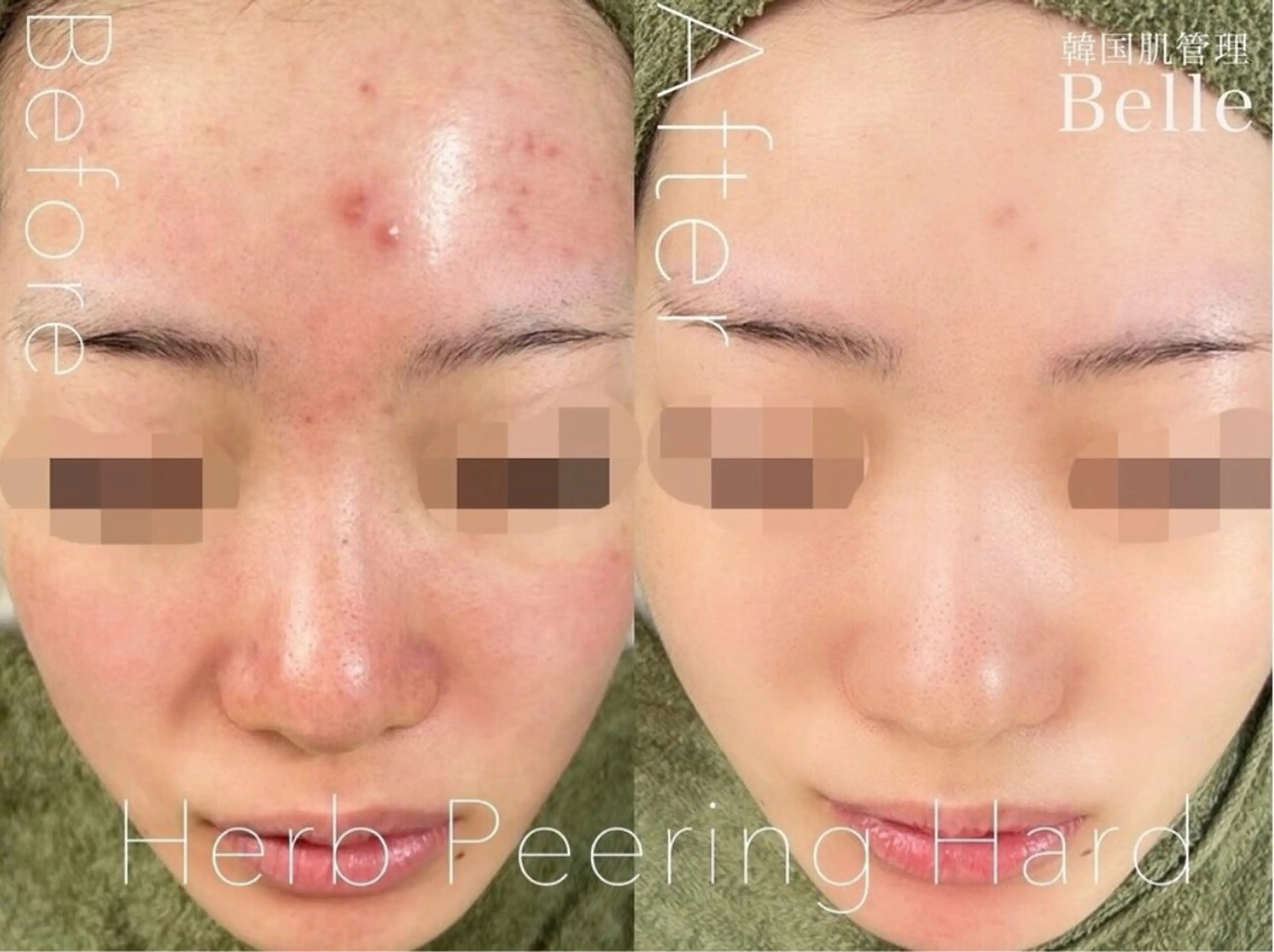 LIME横浜所属・ハーブピーリング🌿 韓国肌管理 Rionのエステ・リラクイメージ