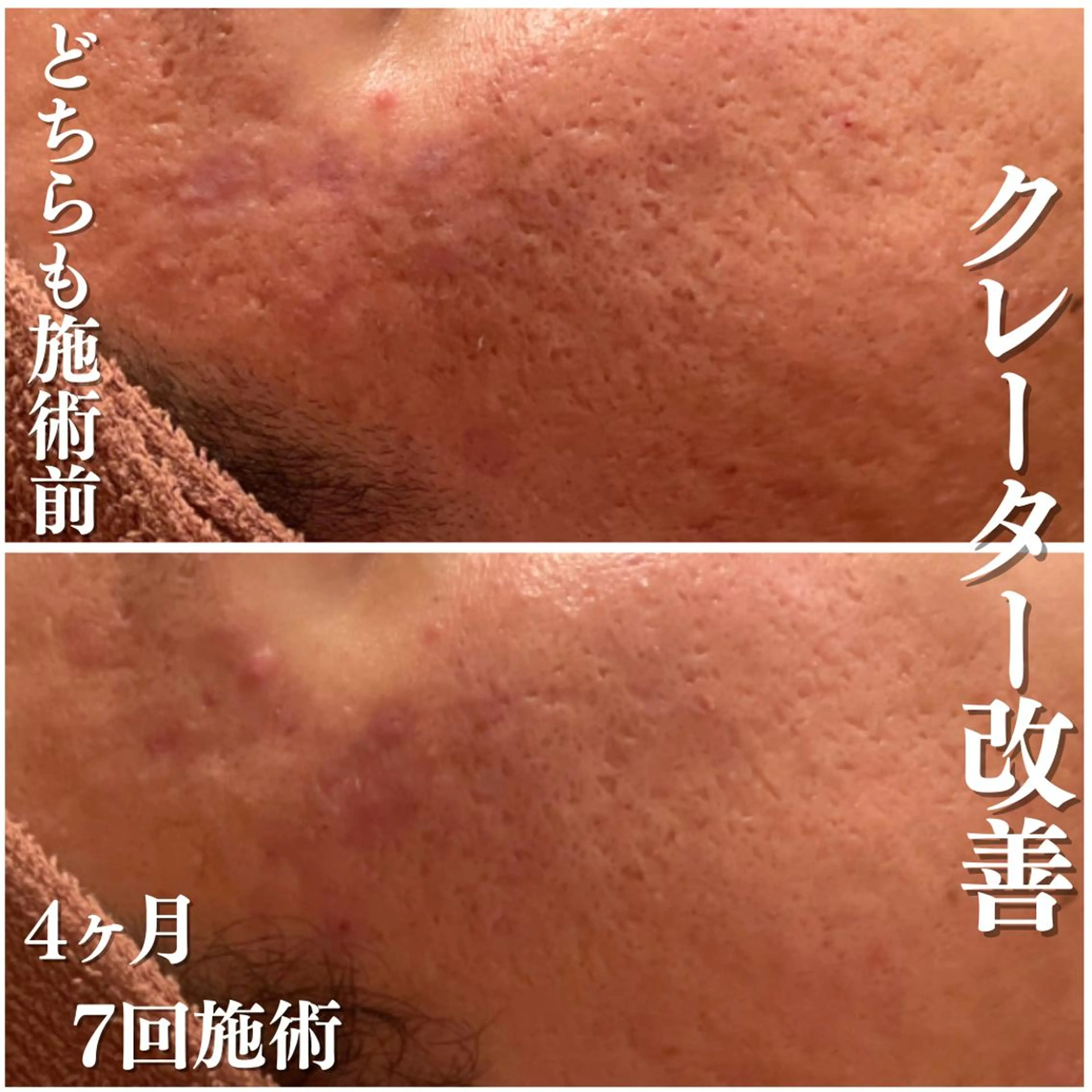 エステ リラク ニキビ跡改善専門🔥 医療にはできない改善のエステ・リラクイメージ