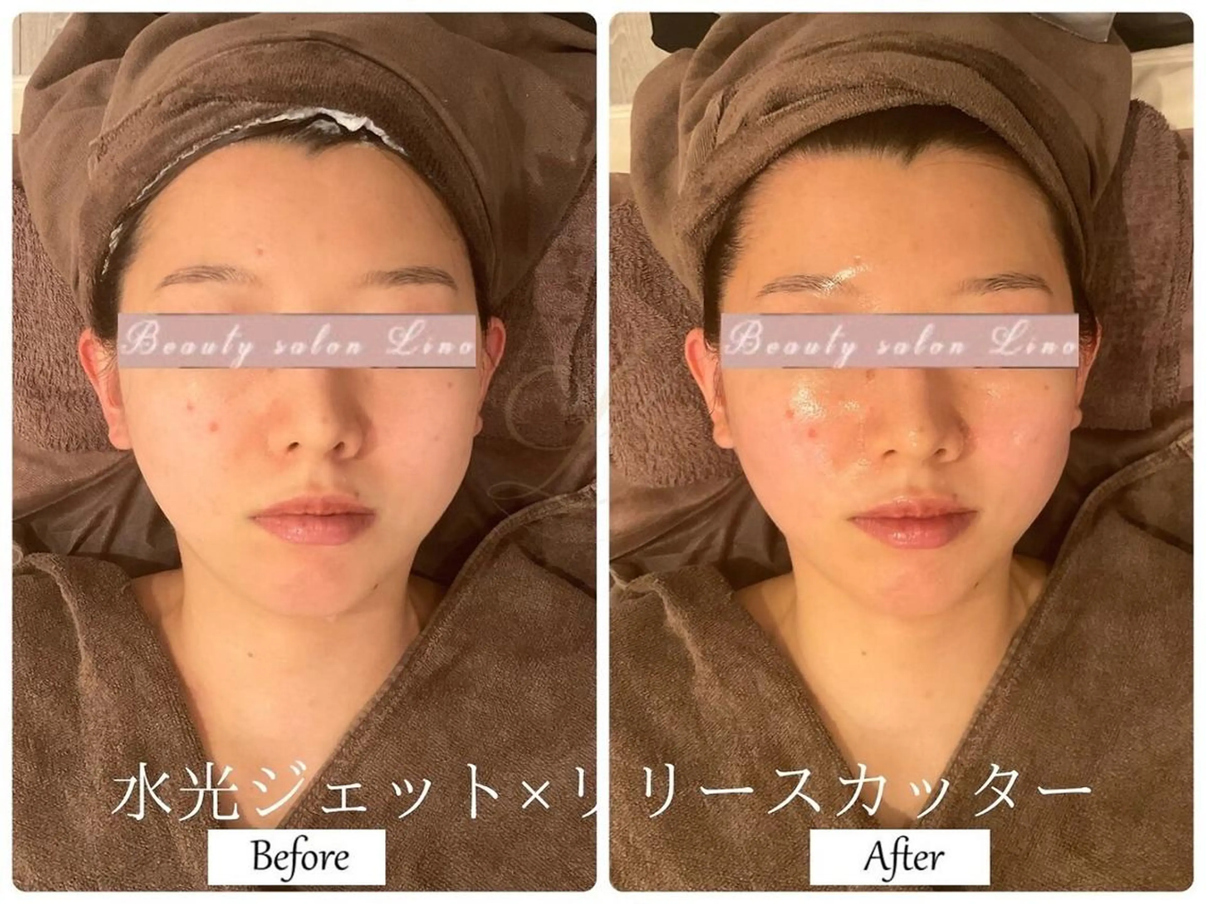 【水光ジェット×リリースカッター】人気No1★潤い水光肌&小顔リフトが叶う♪の写真