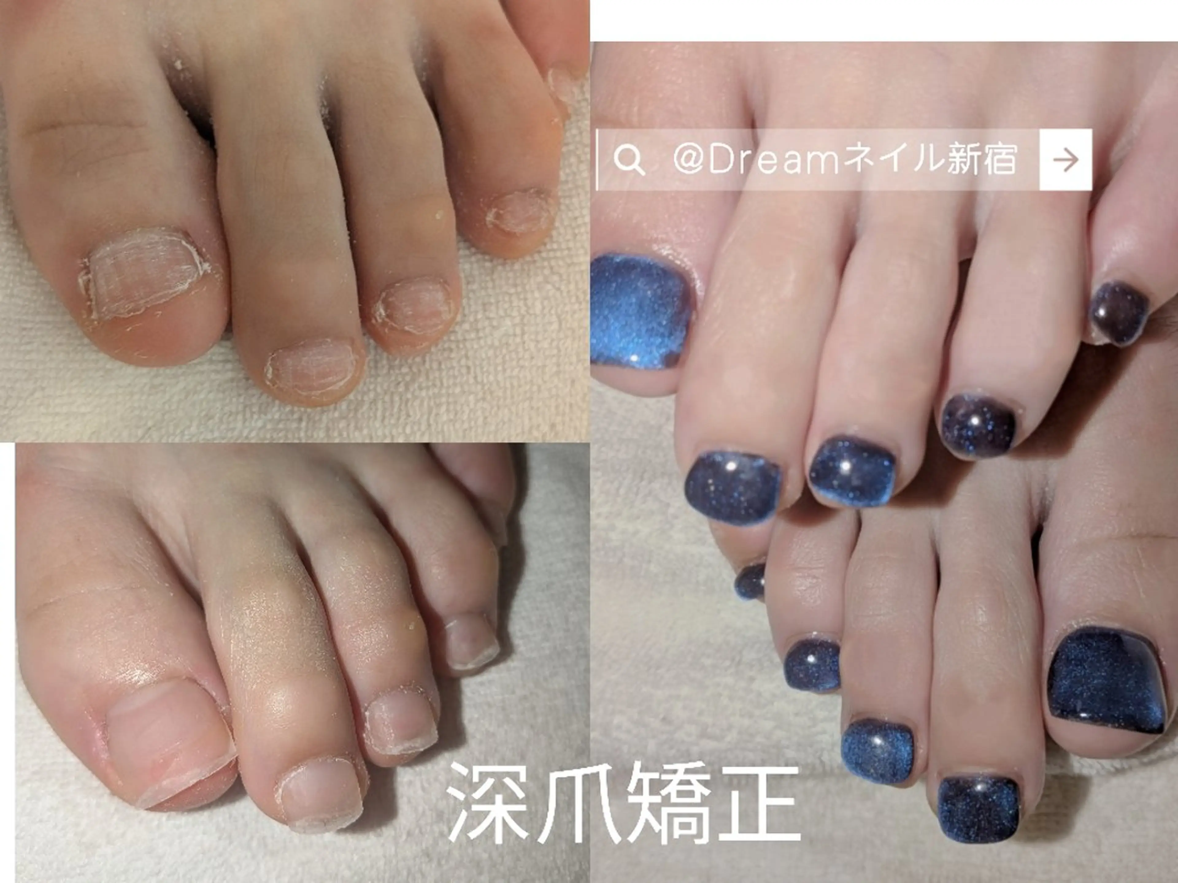 🌟深爪、噛み爪、むしり爪矯正フット長さだしワンカラーコースの写真