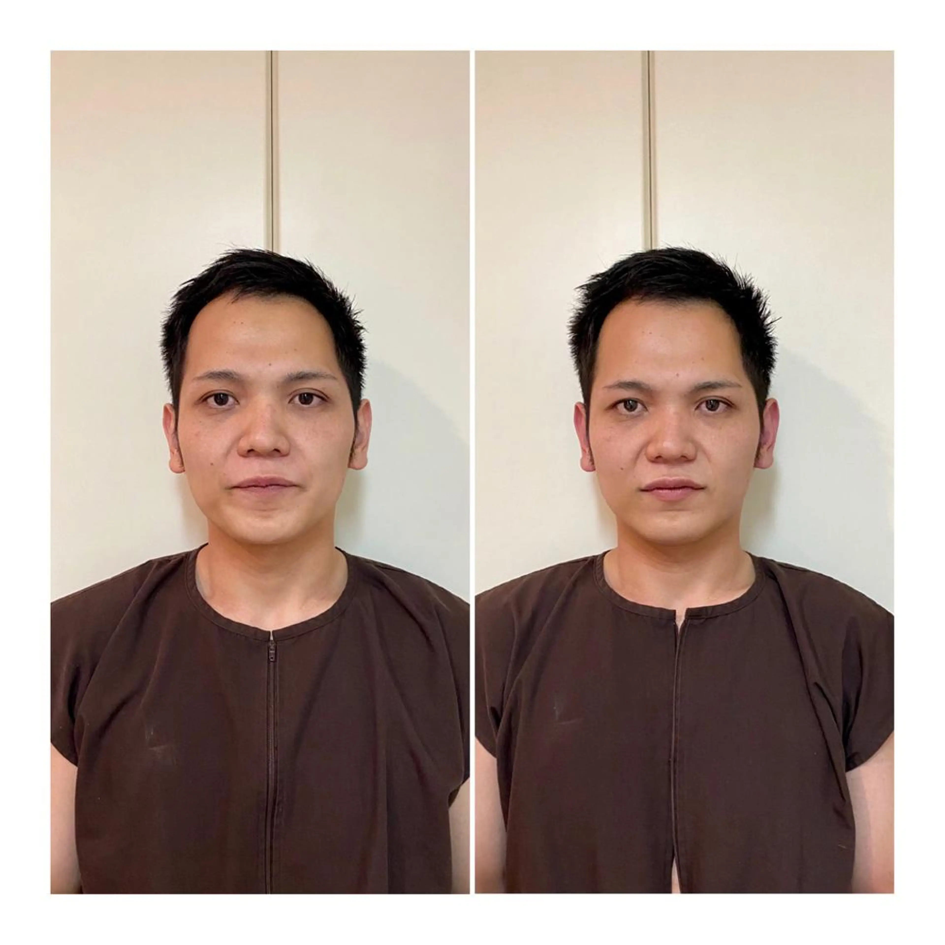 メンズ その他 即小顔♥️美容鍼× ハーブピーリングのその他イメージ