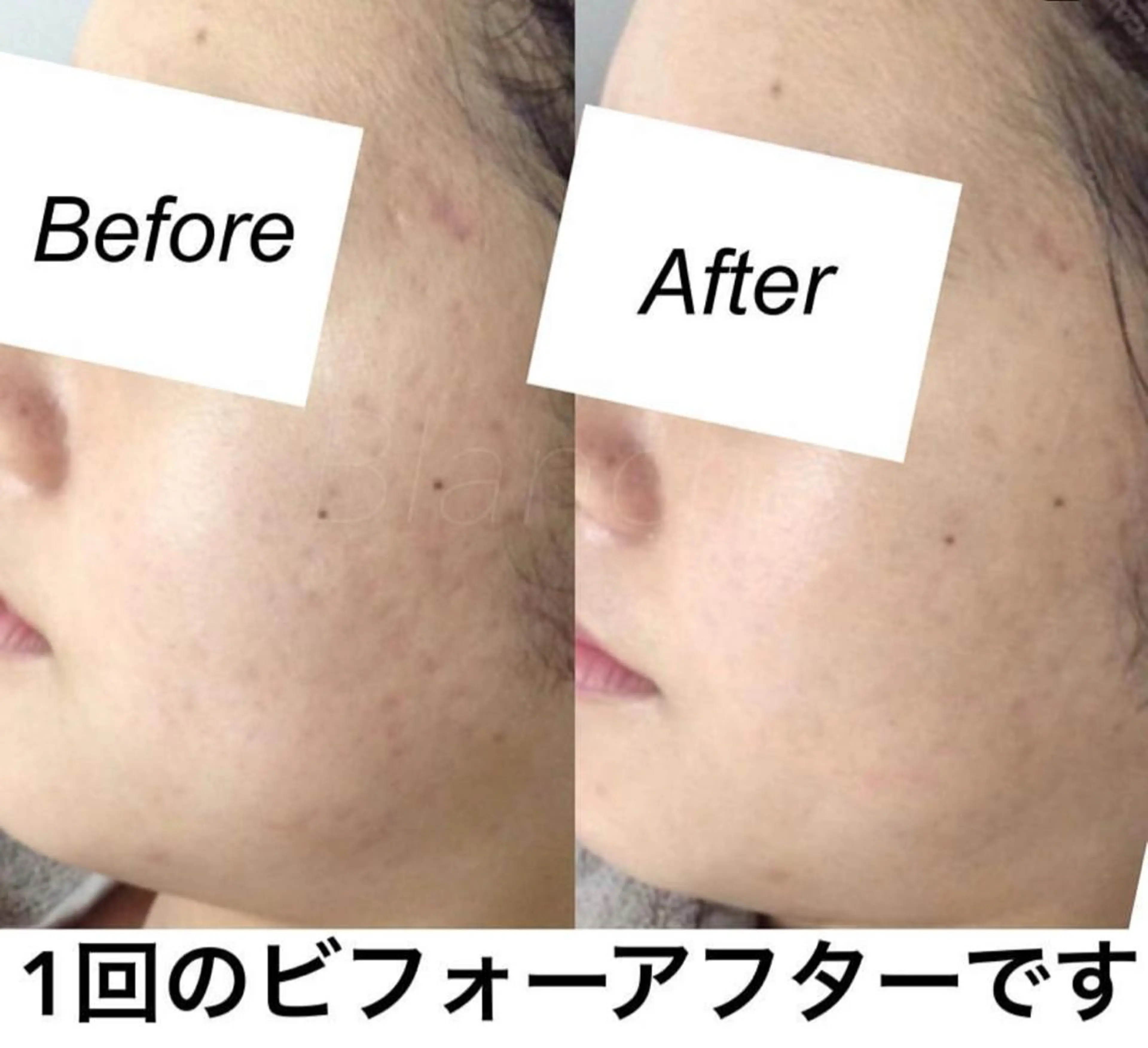 ミディアム カラー パーマ ヘアアレンジ キッズ ネイル マツエク・マツパ エステ リラク 都度払い肌質改善 &脱毛Blancheのエステ・リラクイメージ