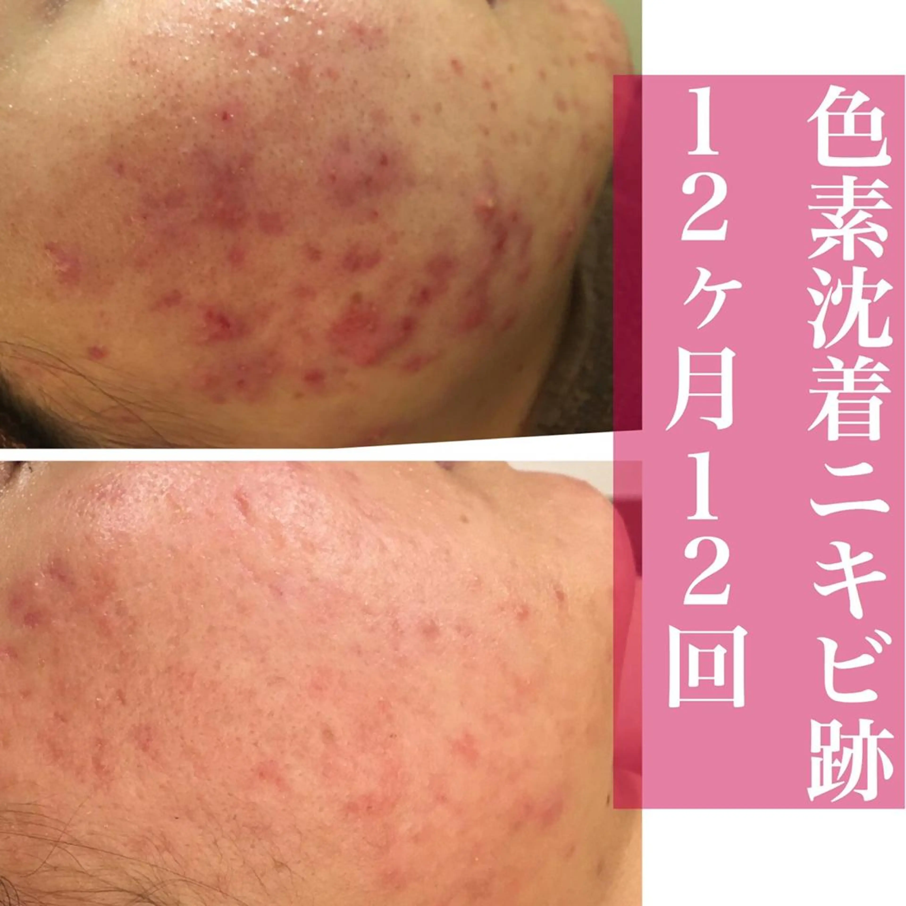 ミディアム カラー パーマ ヘアアレンジ メンズ ネイル マツエク・マツパ アイブロウ エステ リラク アクール　齋藤 ♡肌トラブル卒業のエステ・リラクイメージ