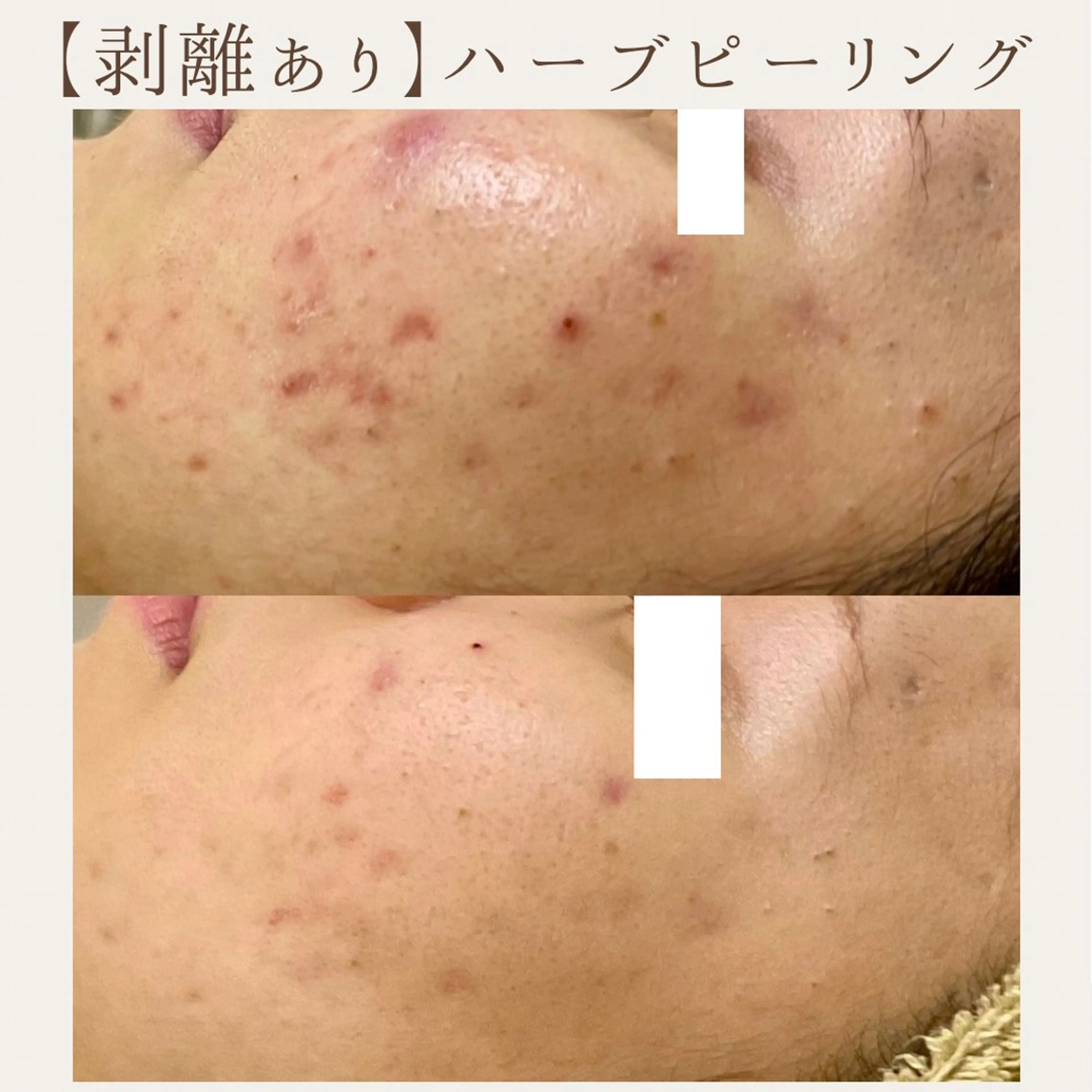 エステ 肌質改善サロン renew所属・肌質改善サロン renew/ｳｴｷのエステ・リラクイメージ