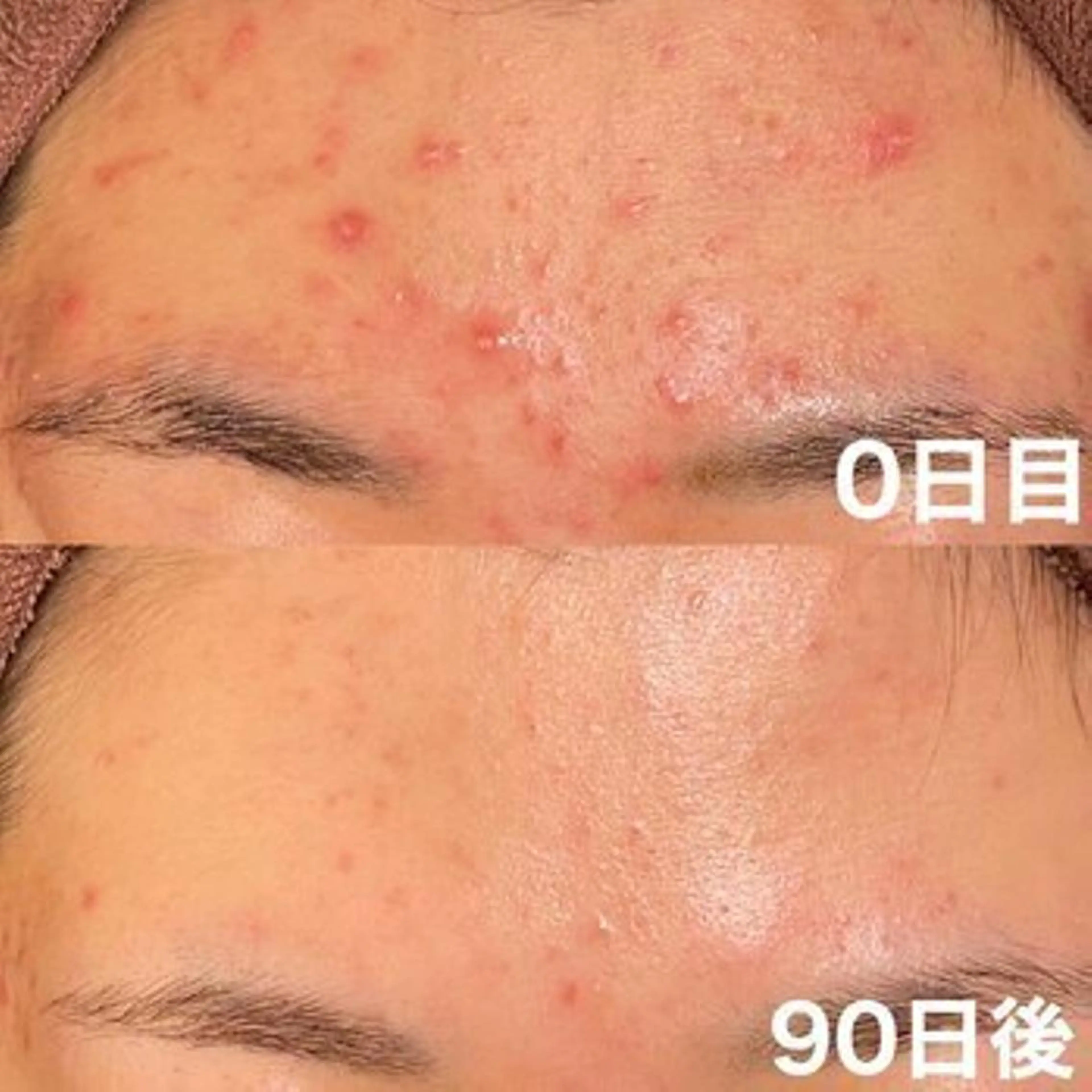 エステ リラク 皮膚科より効果あり ⁉️最短ニキビ改善のエステ・リラクイメージ