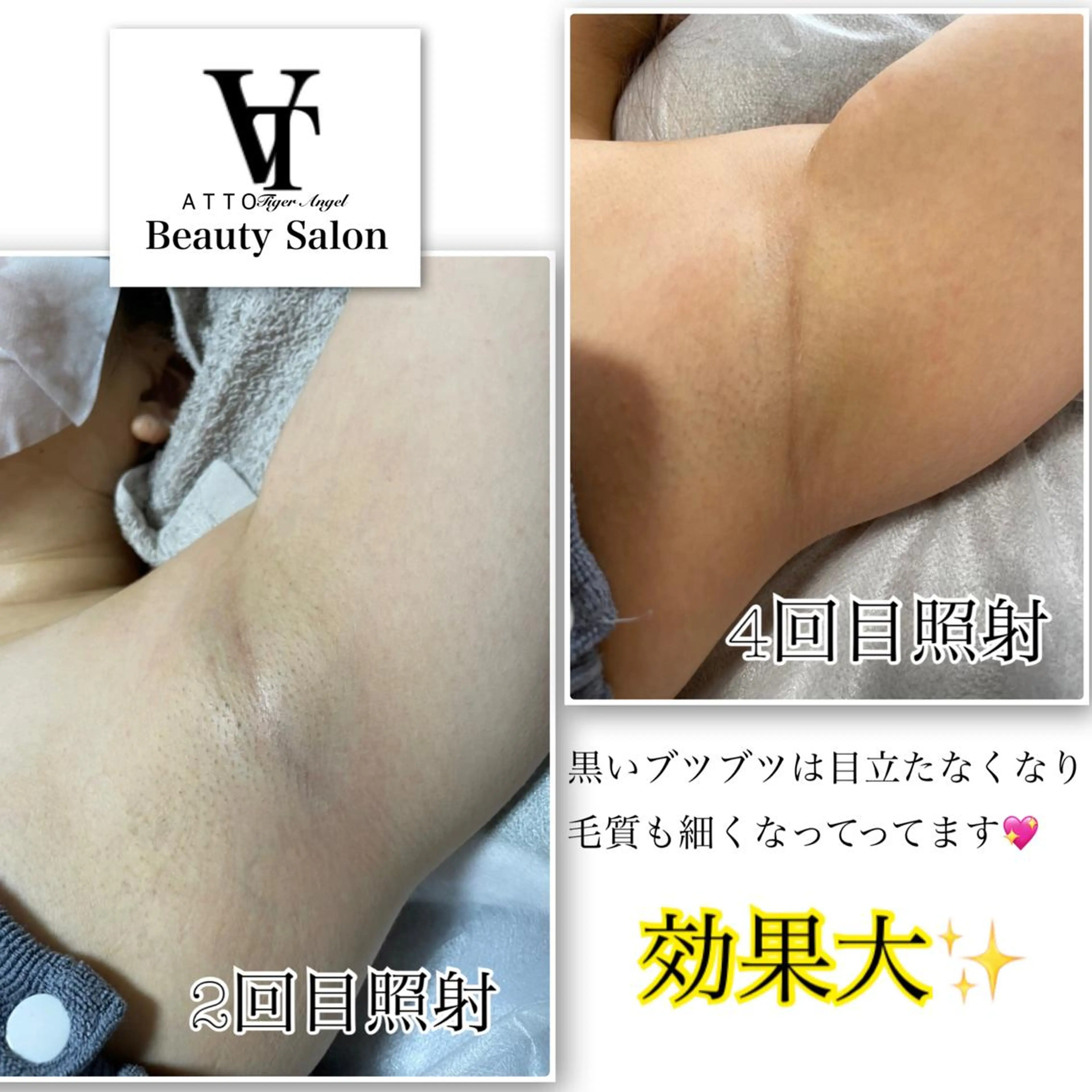 【男女OK】まだ間に合う！！！✨腕+手(指先まで)+ワキの写真