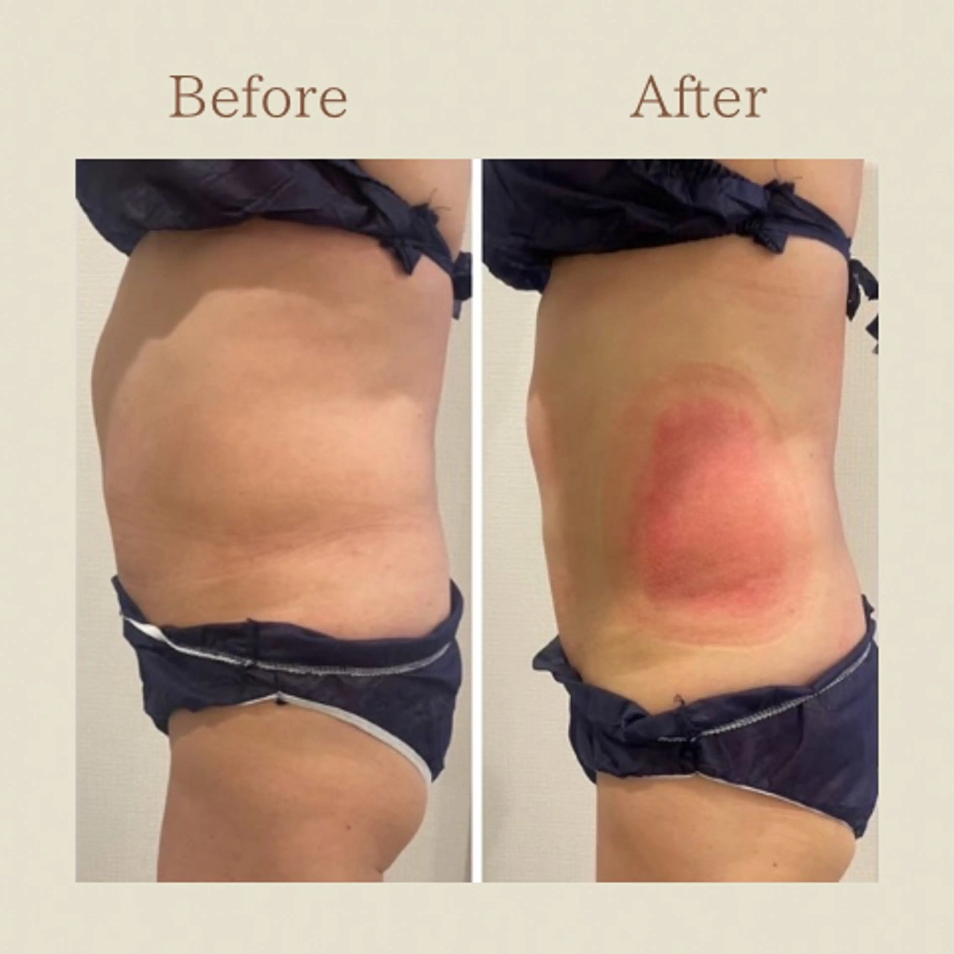 お腹痩せエステ Flat BELLY 恵比寿所属・【腸もみ/脂肪冷却】 お腹エステ/恵比寿のエステ・リラクイメージ
