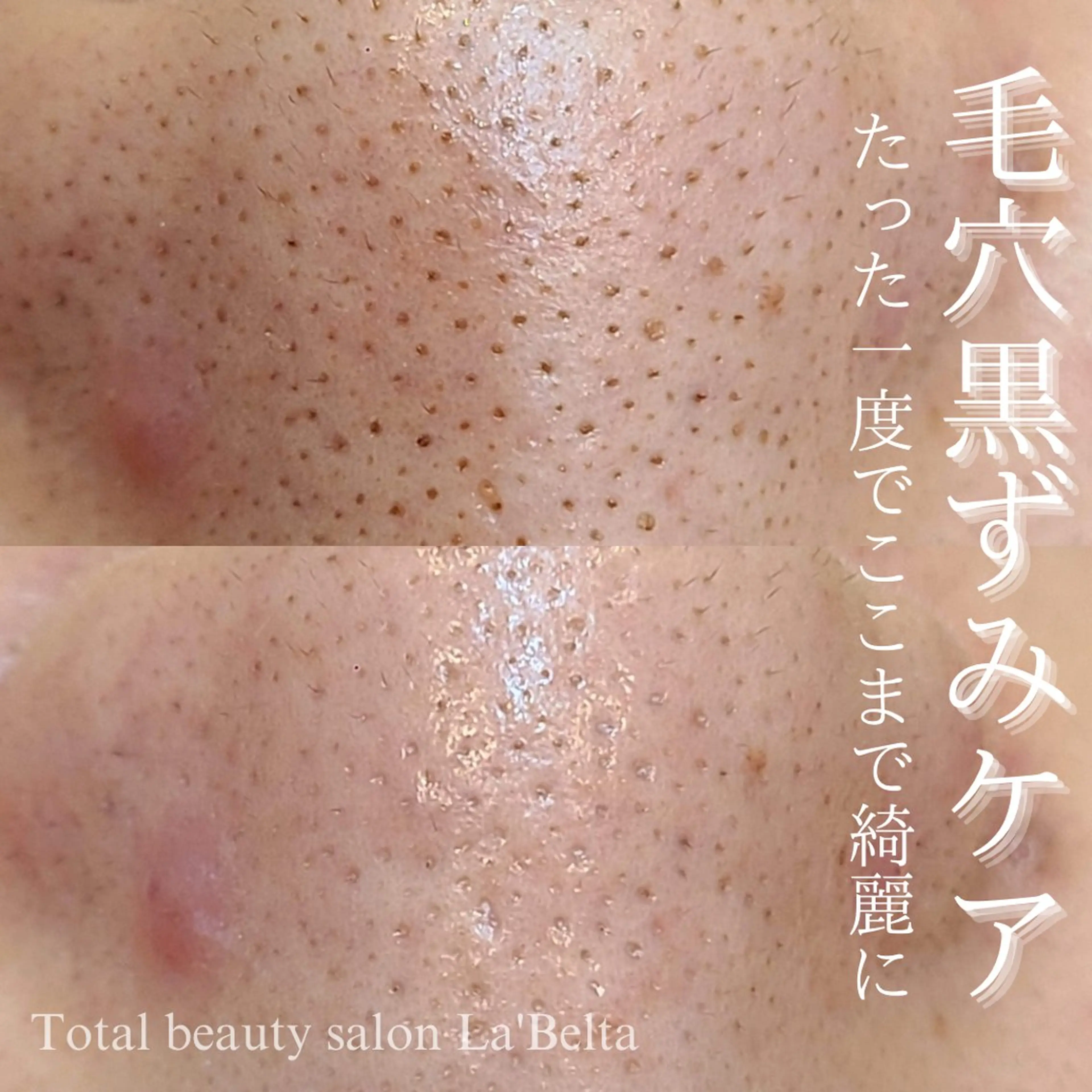 毛穴吸引＋スクラブクレイ洗顔＋セラミドケア✨黒ずみ、角栓、毛穴の開きが気になる方必見🫣✨の写真