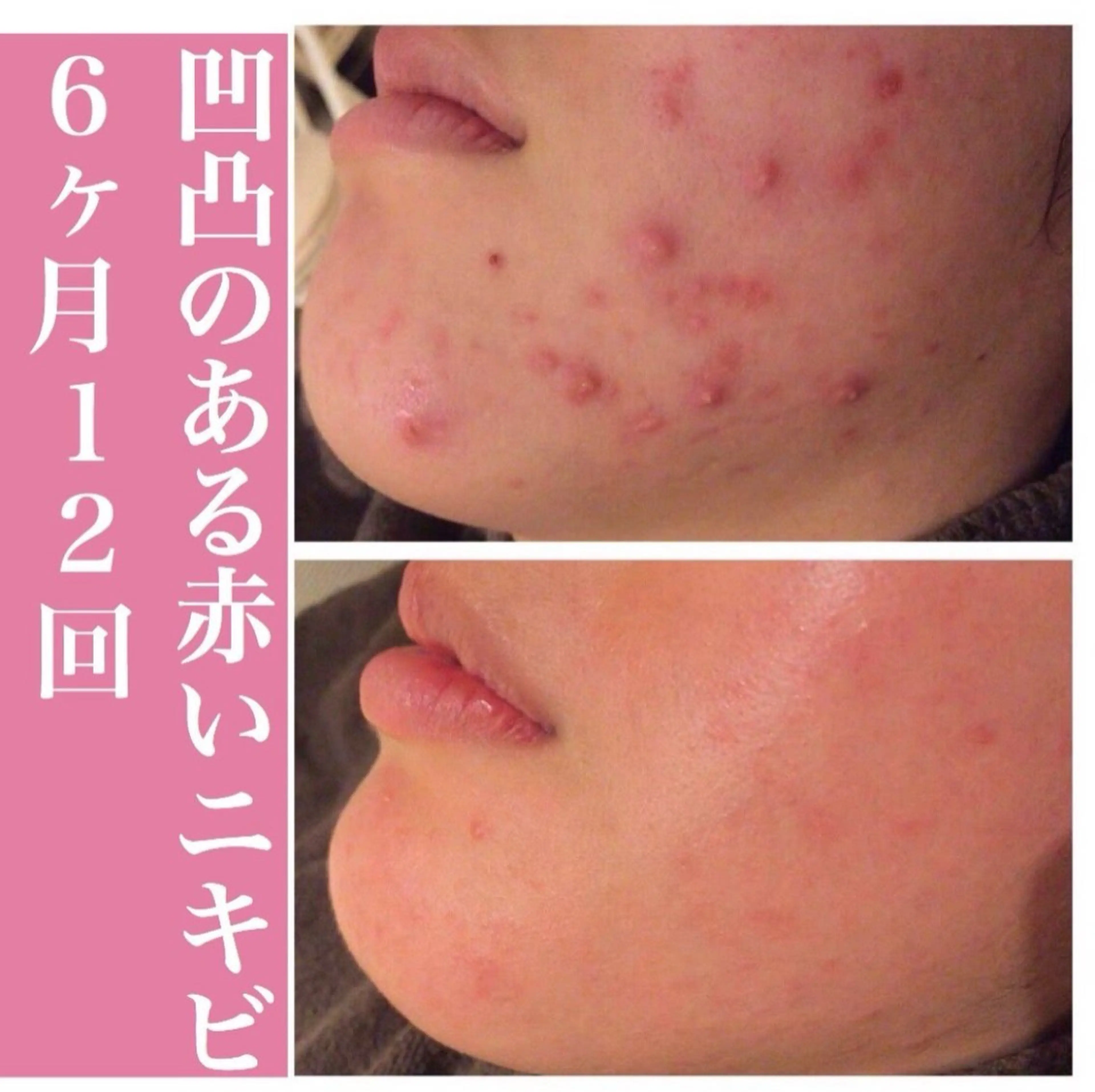 学生ニキビ改善🍀 優しい肌質改善のエステ・リラクイメージ