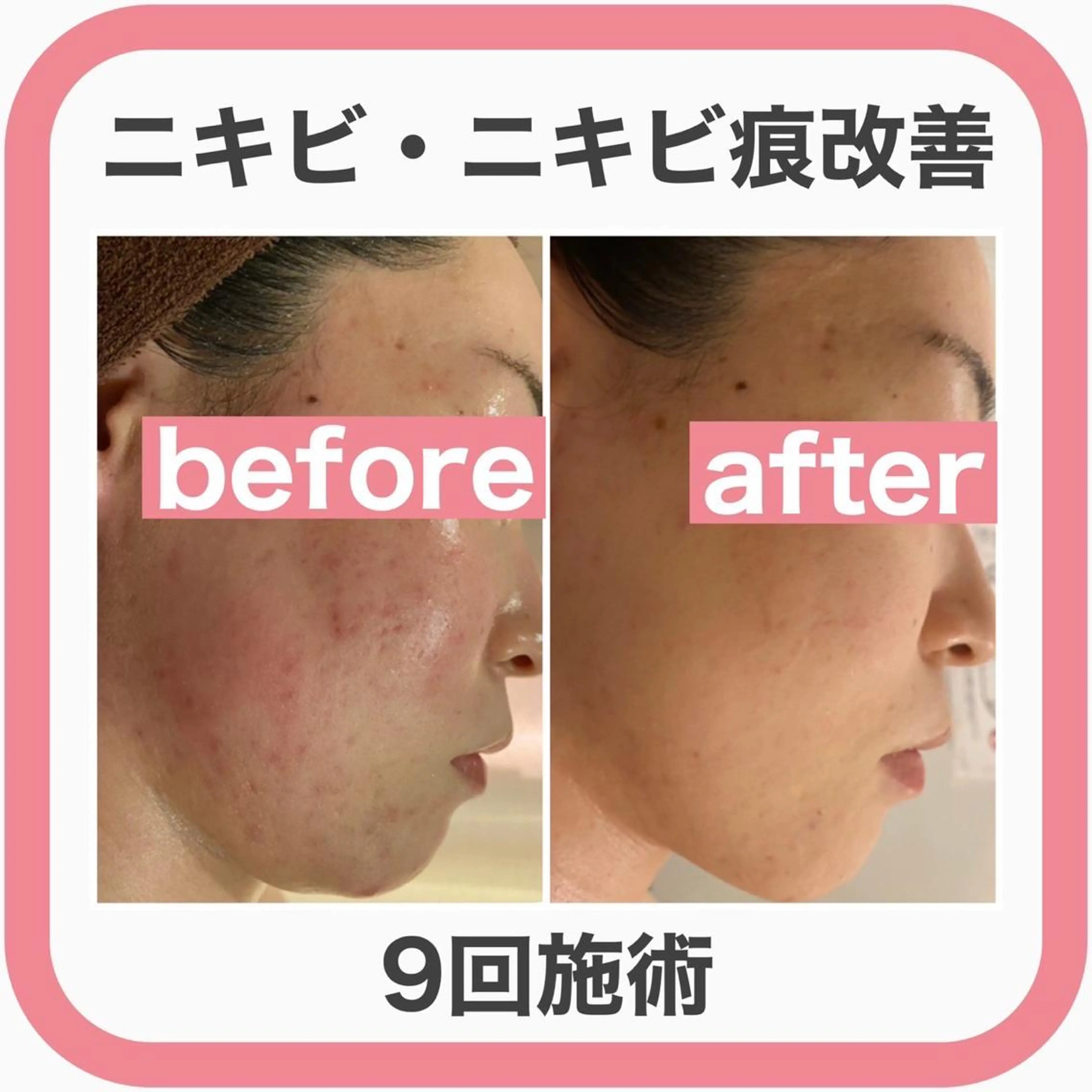 セミロング カラー パーマ ヘアアレンジ メンズ キッズ ネイル マツエク・マツパ アイブロウ エステ リラク ニキビ特化型エステ 🍋最短で肌質改善のエステ・リラクイメージ