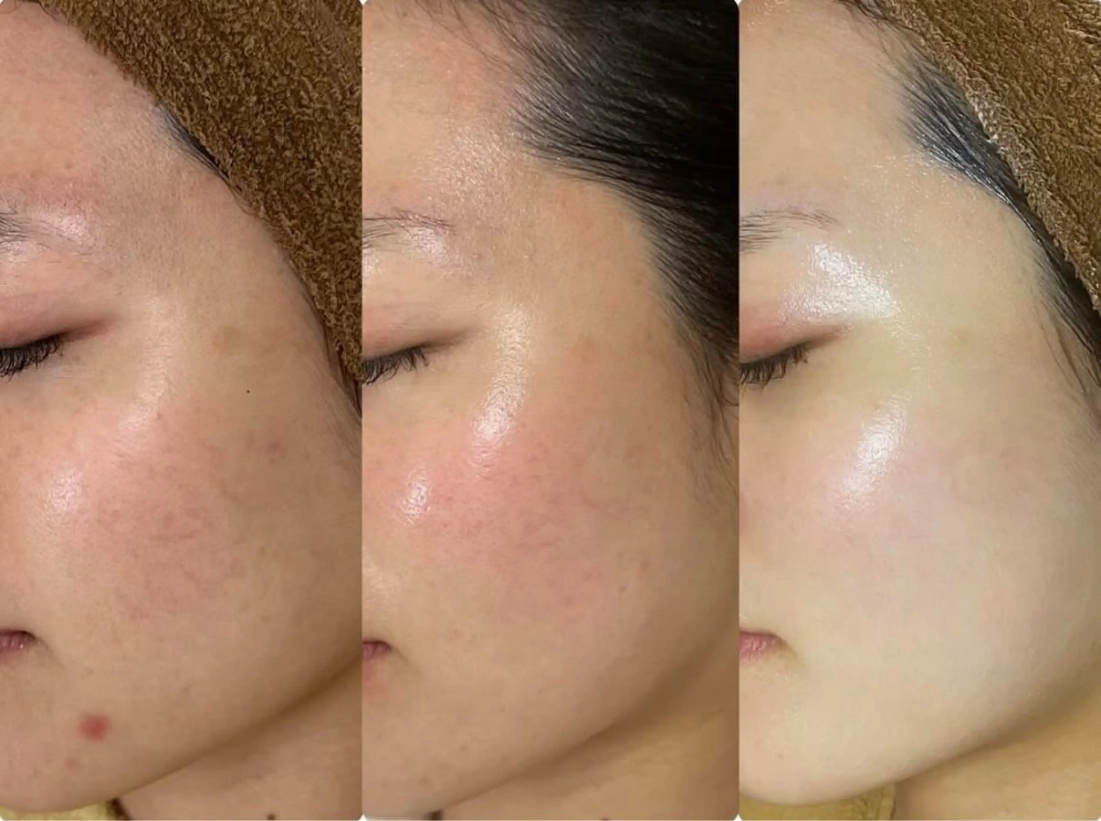 エステ エステサロン-mignon-所属・mignon 脱毛/ ローマピンク/耳ツボのその他イメージ