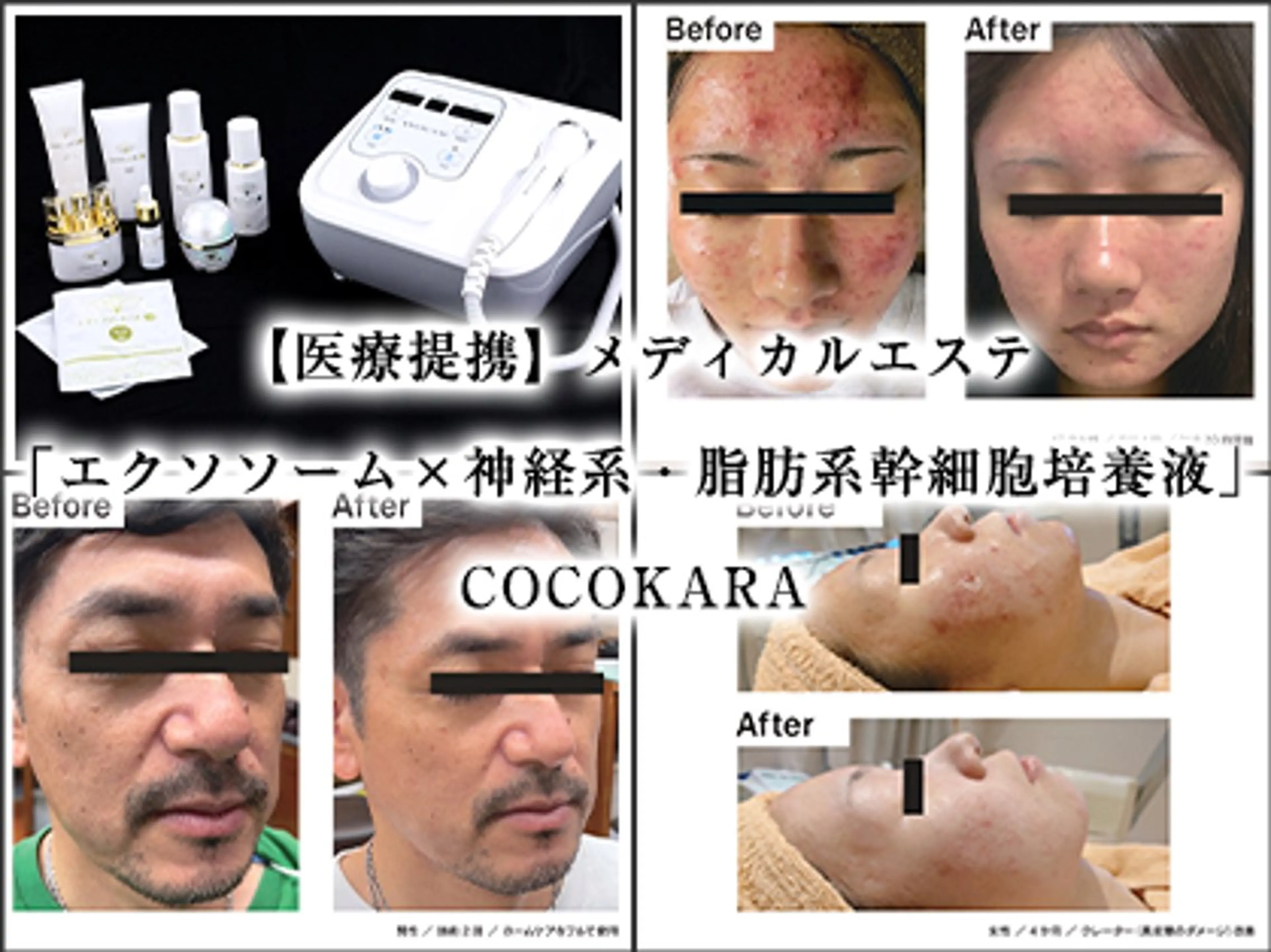 【結果重視】神経幹細胞導入☆しみ、しわ、美白改善コース体験💆‍♀️✨️の写真