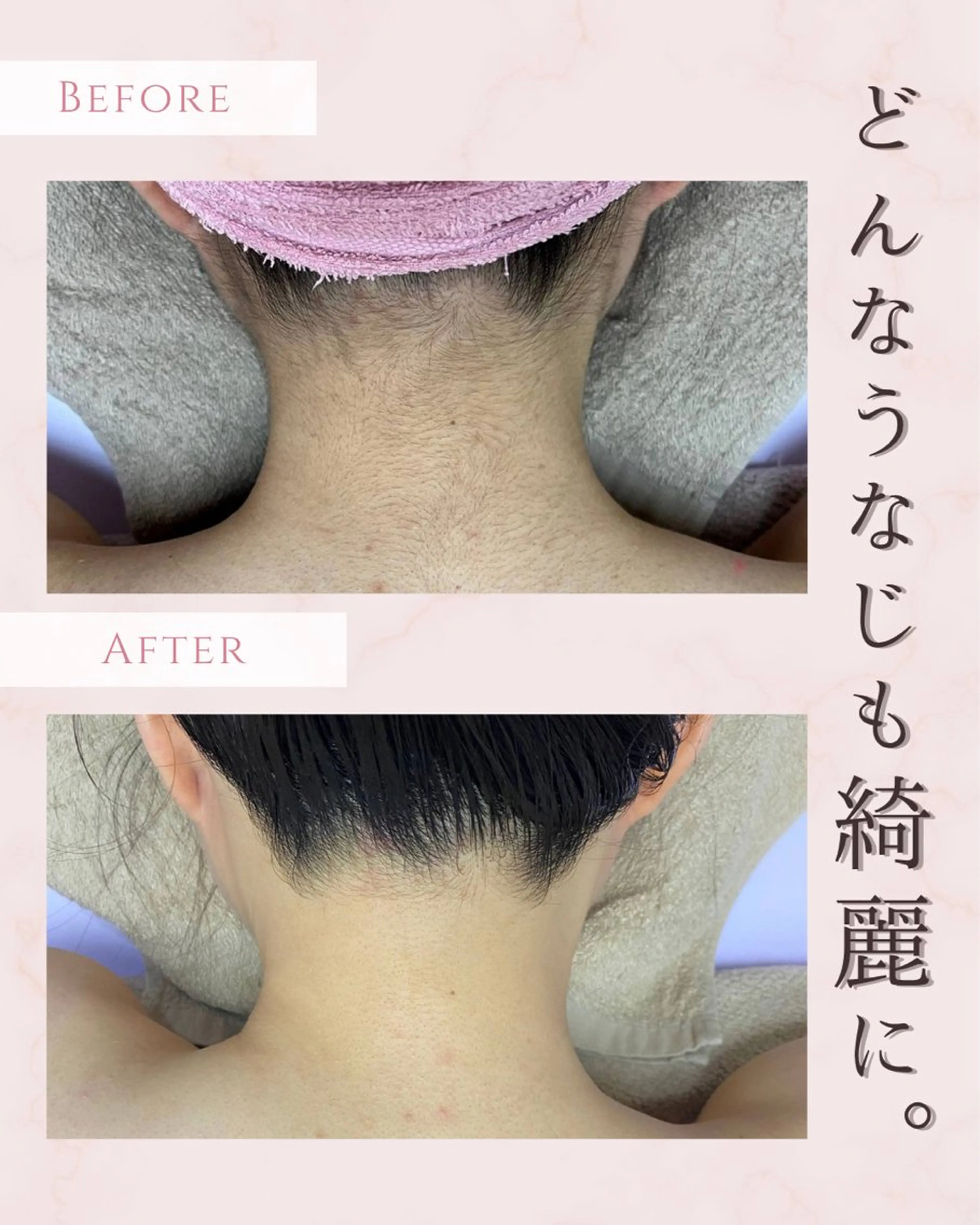 うなじ脱毛の写真
