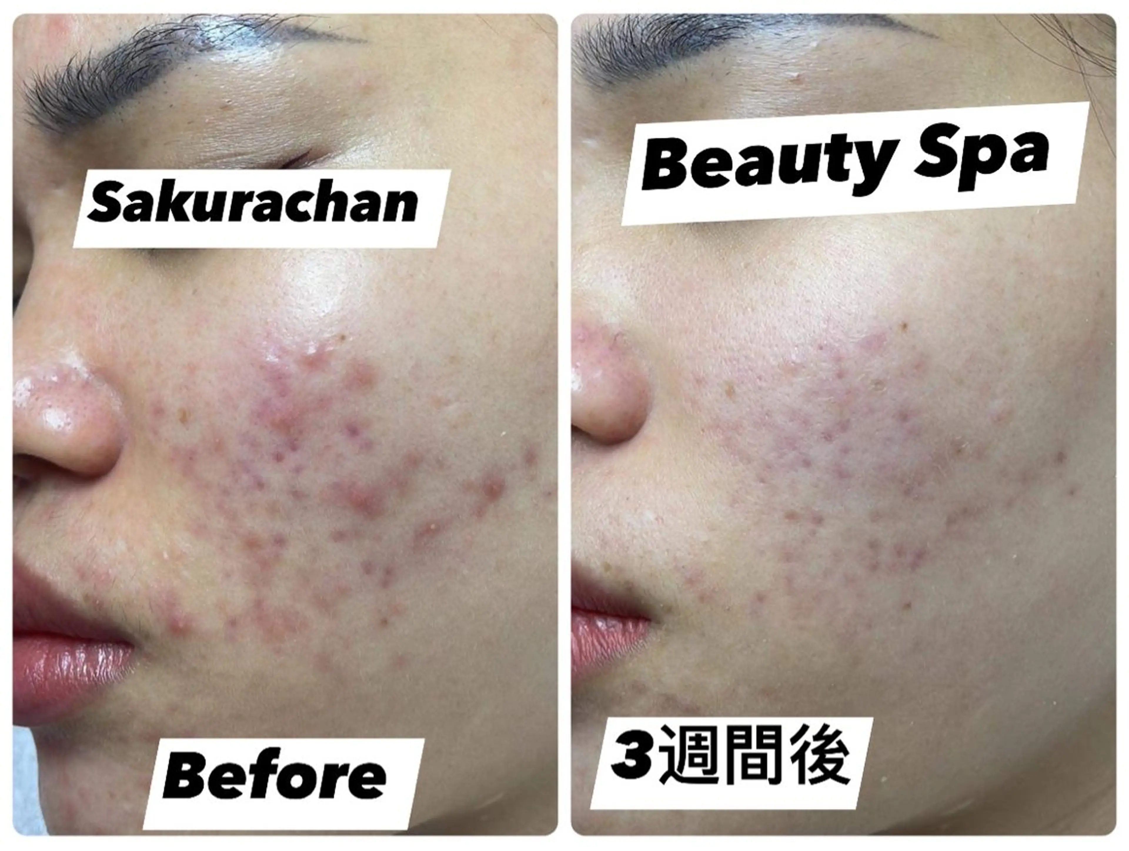 エステ リラク ニキビ、痩身、脱毛、 サクラチャンスパのエステ・リラクイメージ