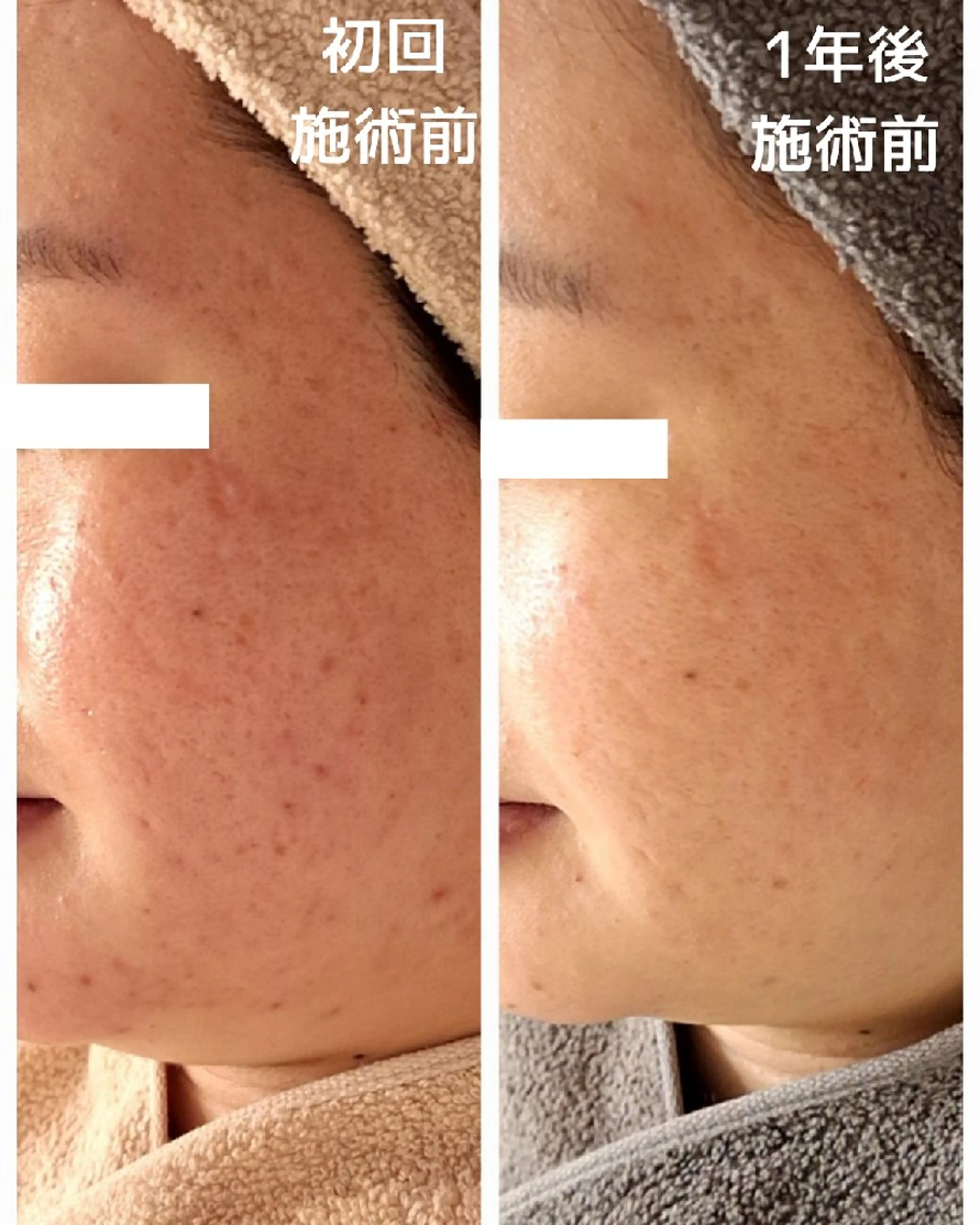 【ララピールの進化版!】セラピール+美容液導入 50分の写真