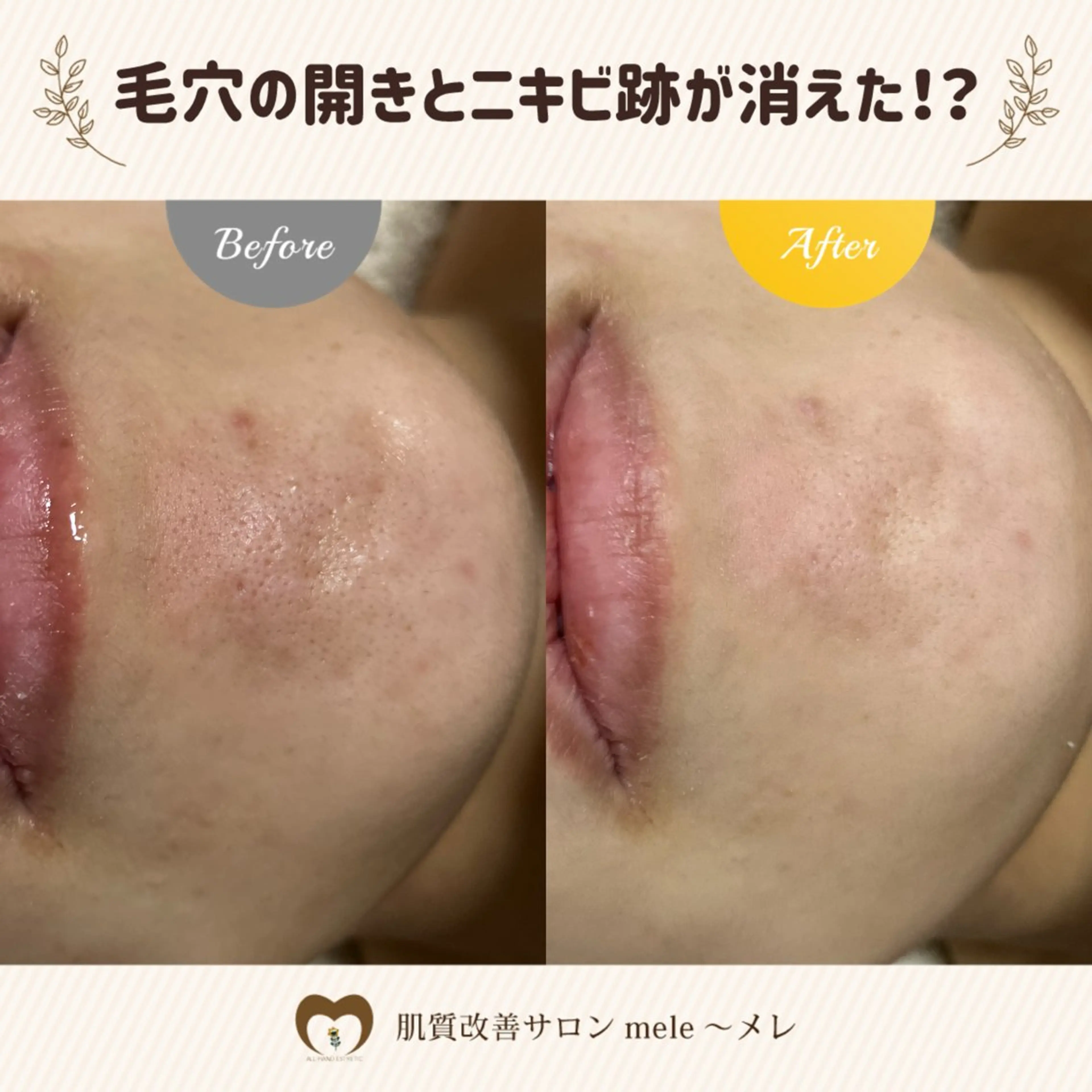 ニキビケア/毛穴/ 赤み/自信の肌✨森園のエステ・リラクイメージ