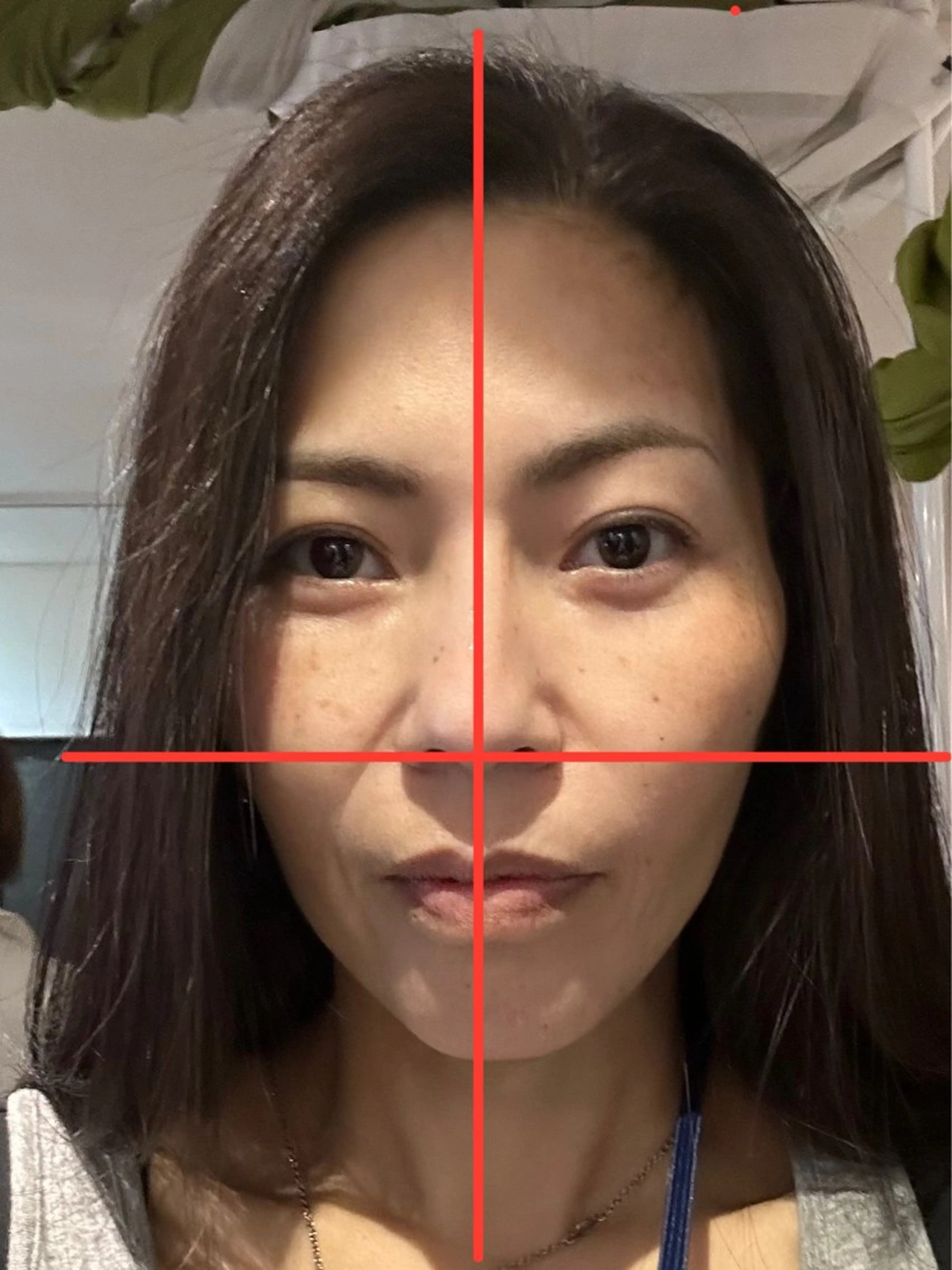 切らない糸リフトの写真