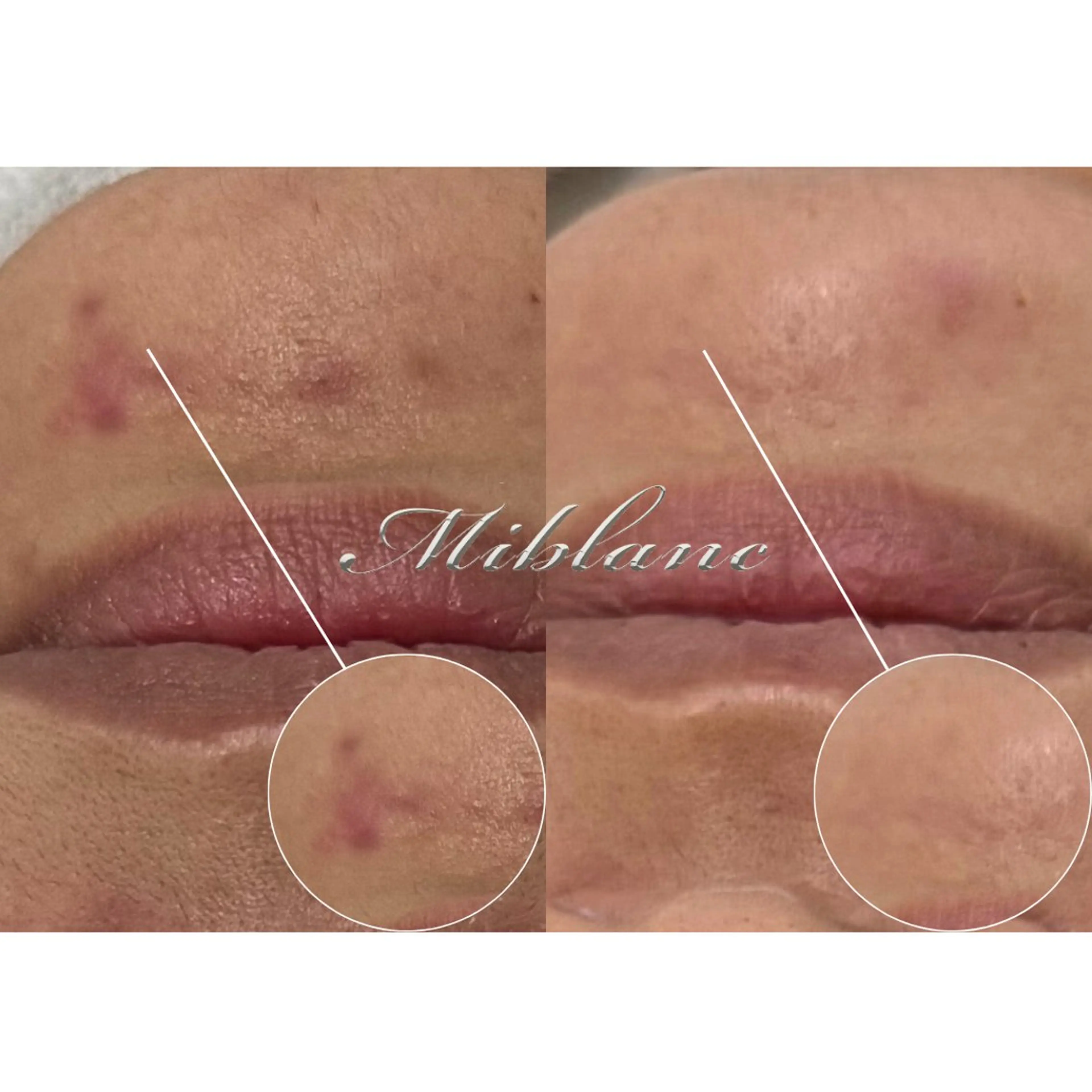 11月𝘤𝘢𝘮𝘱𝘢𝘪𝘯🍁【人気No1】SNS話題＊クリスティーナハーブピーリング 通常価格¥15,300→の写真