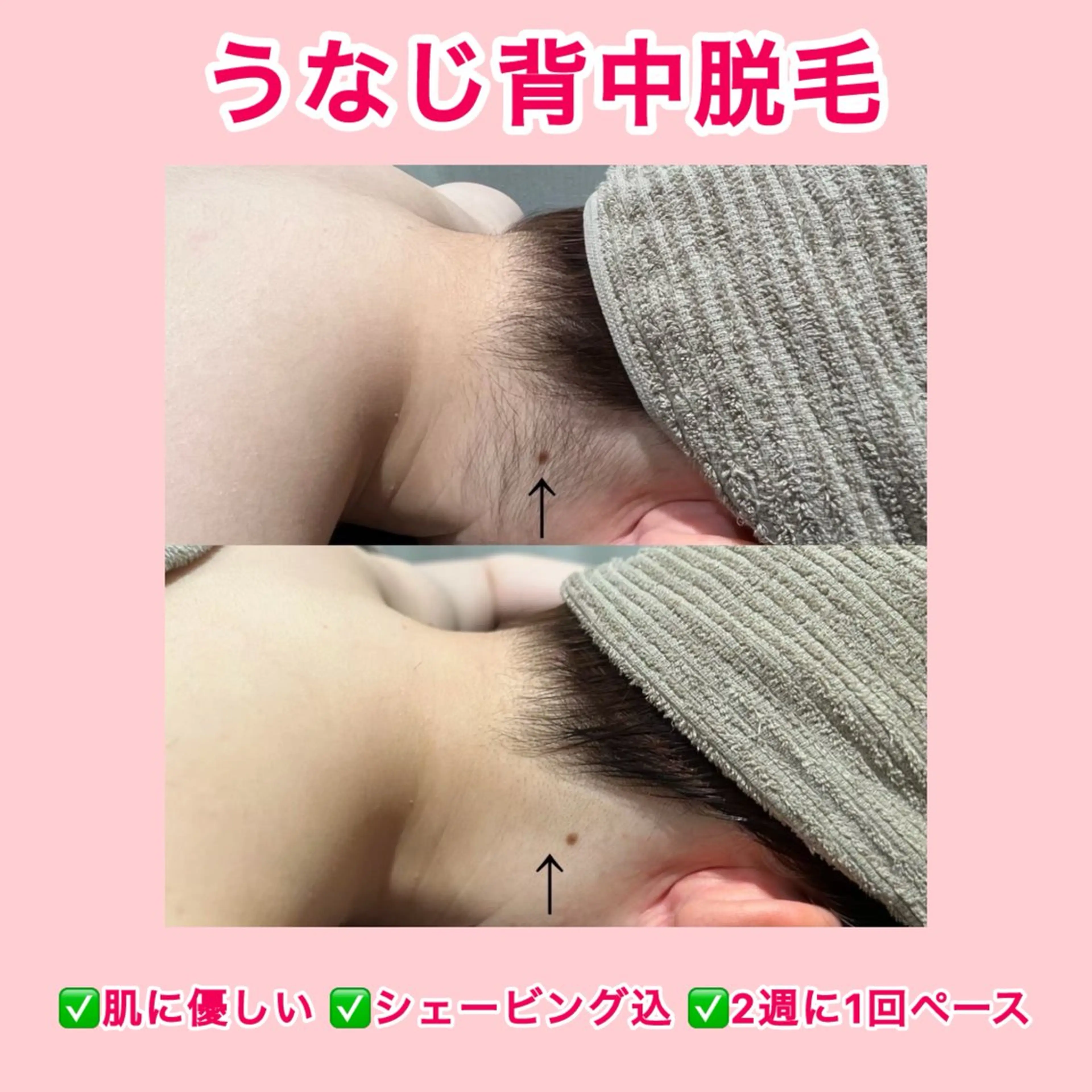7・8月限定！【うなじ➕背中脱毛】無料シェービング付き/最新機器/うなじ美人を叶えます♪の写真