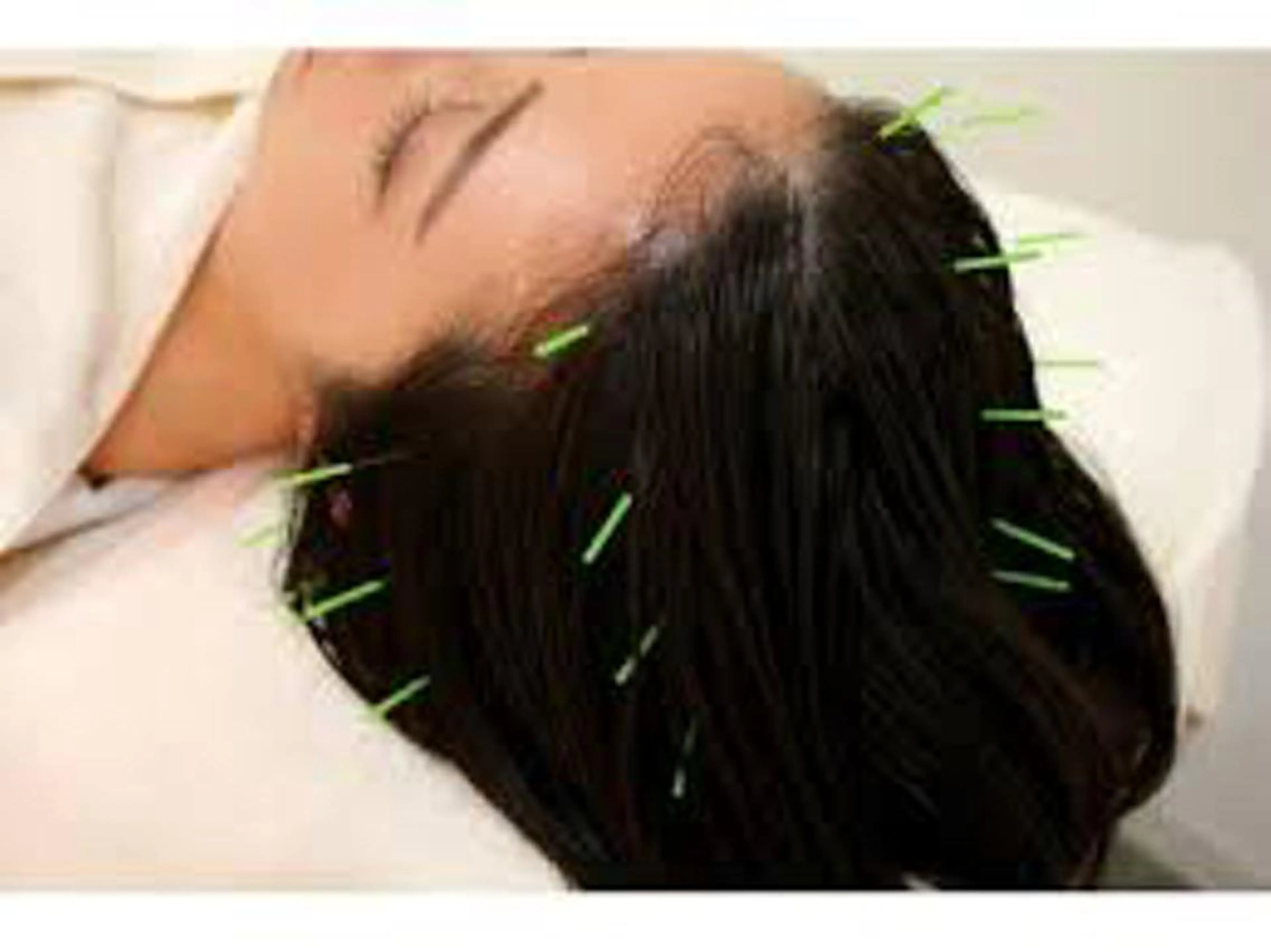 Acupuncture  salon LINOA リノア鍼灸院所属・ヘッドスパ鍼/小顔鍼 耳ツボ 　LINOAのエステ・リラクイメージ