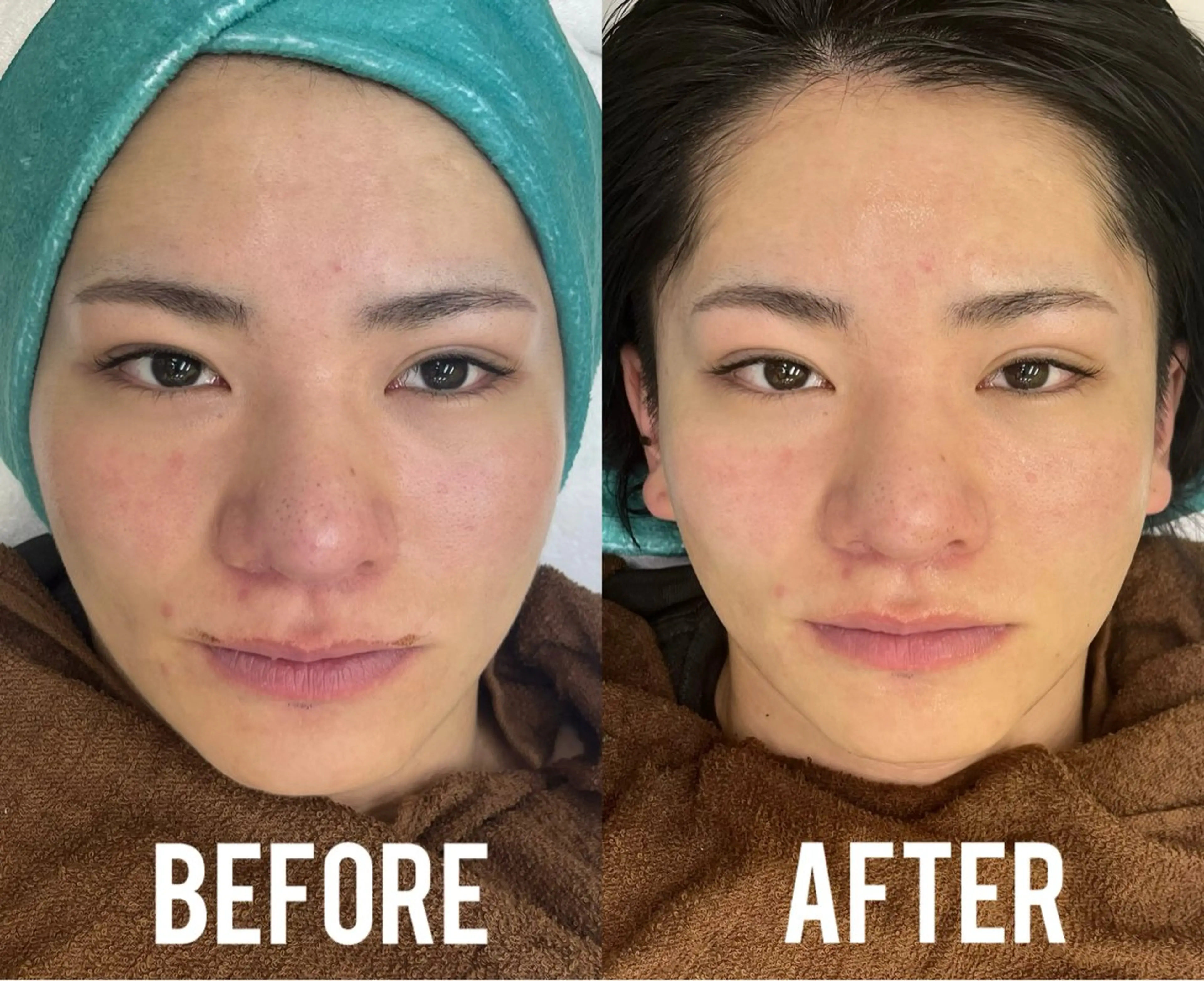 一瞬で小顔‼️切らない脂肪吸引!シャープラインリフト✨の写真