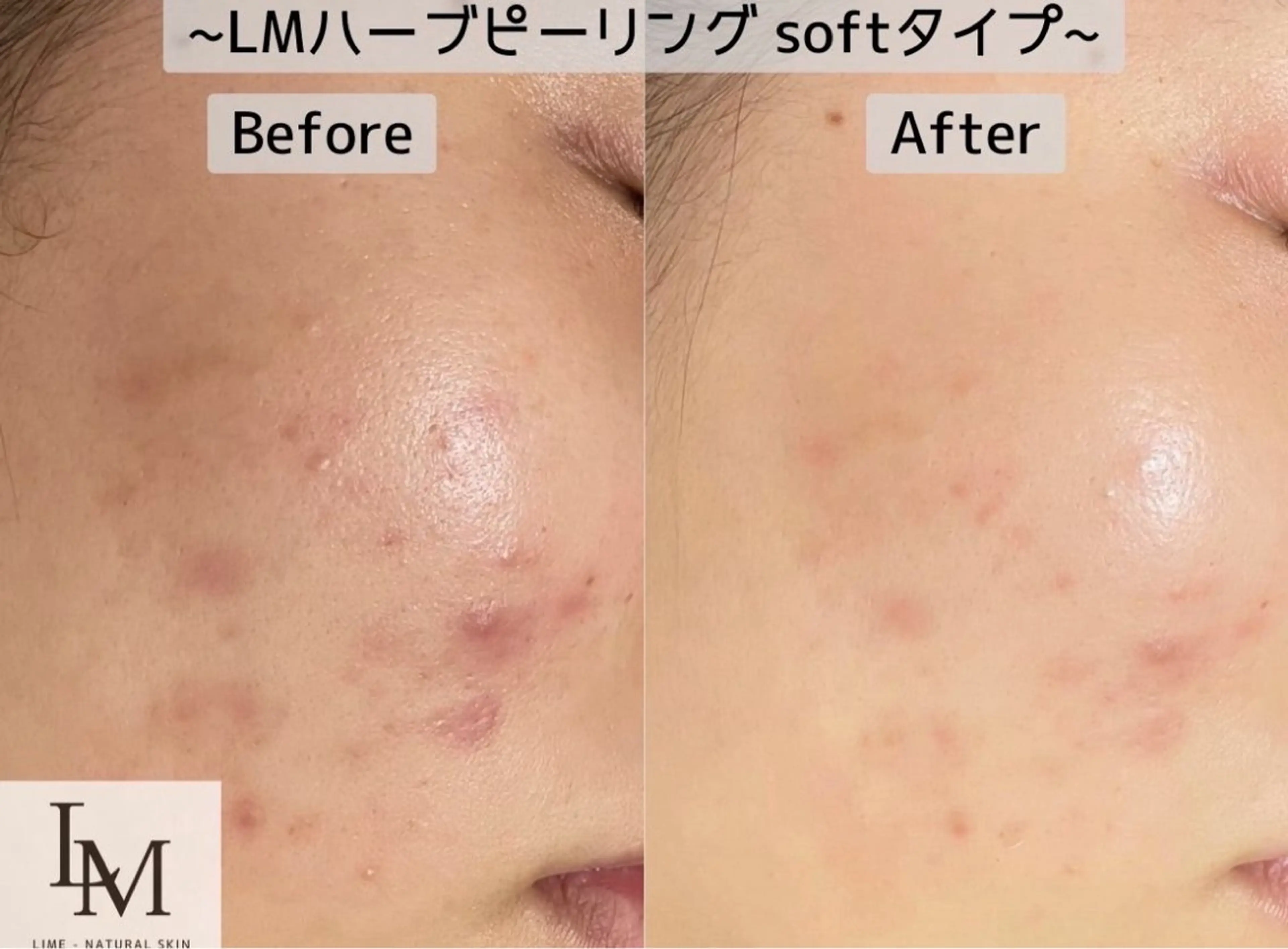 メンズ ハーブピーリング LIME池袋東口店のエステ・リラクイメージ