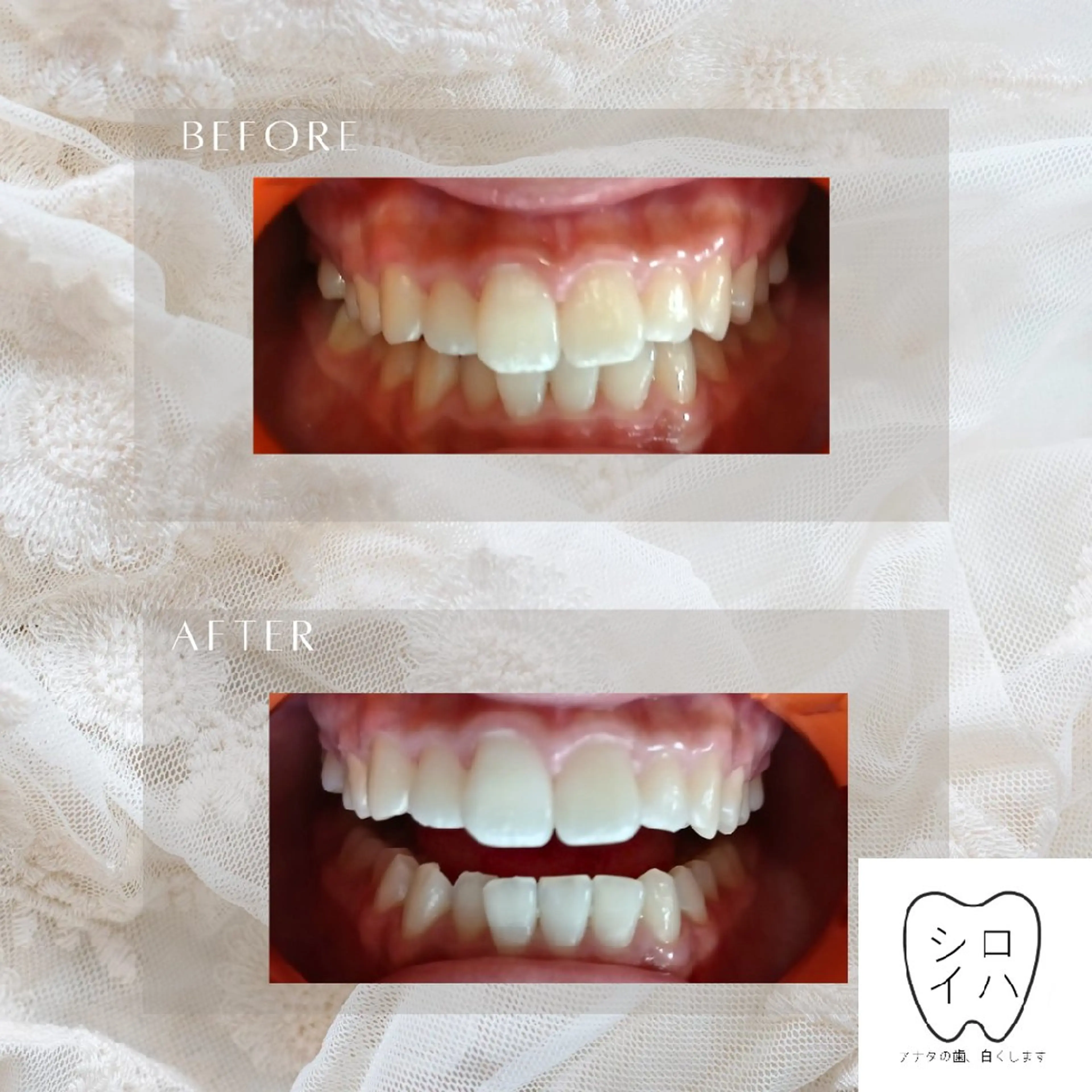 ホワイトニングサロン シロイハ所属・歯を白くしたい方🦷 シロイハのその他イメージ