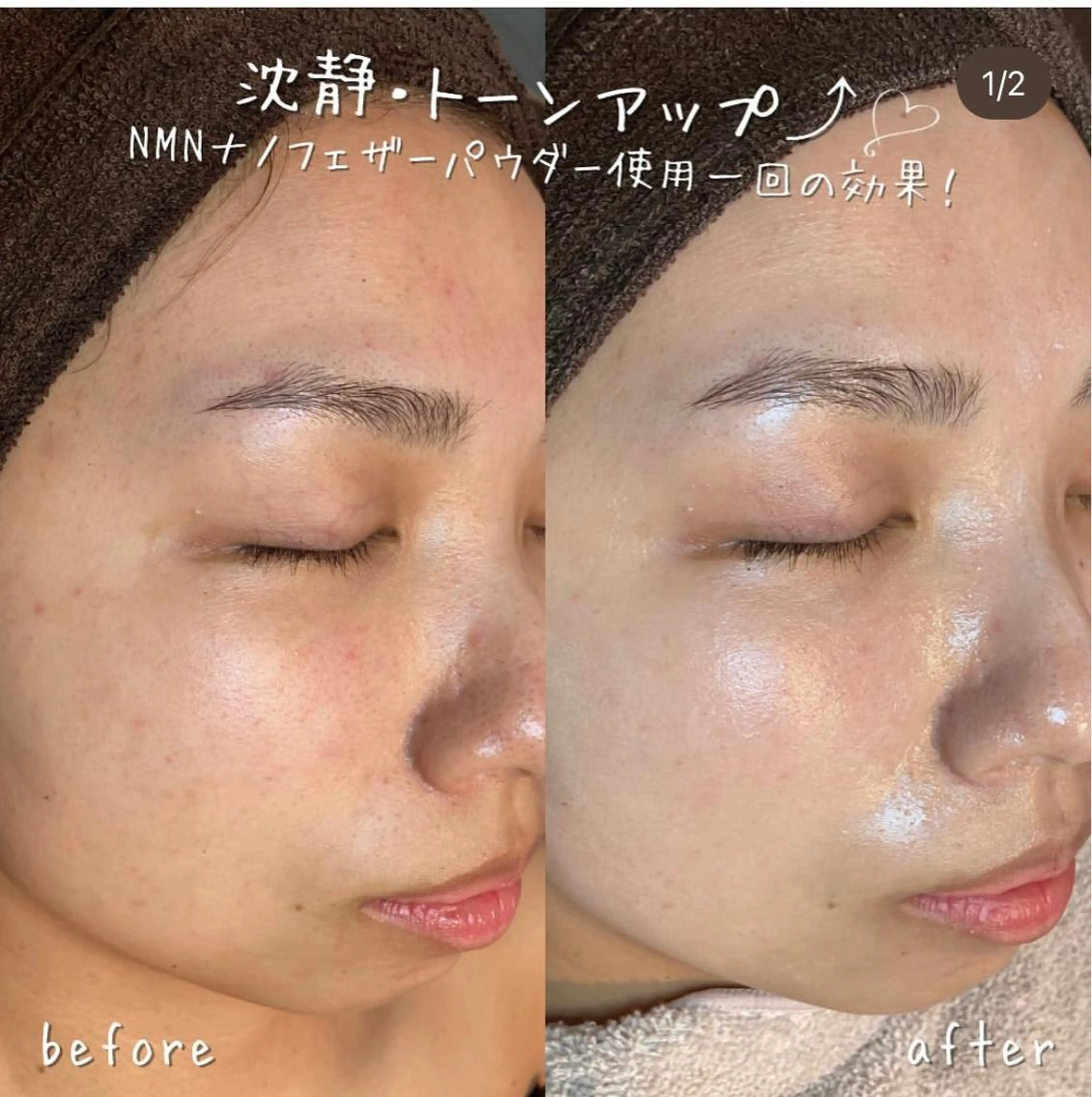 【ハーブピーリング/毛穴洗浄】NA skin 川崎店〜ニキビ・毛穴専門店〜所属・NAskin川崎 皆川のエステ・リラクイメージ