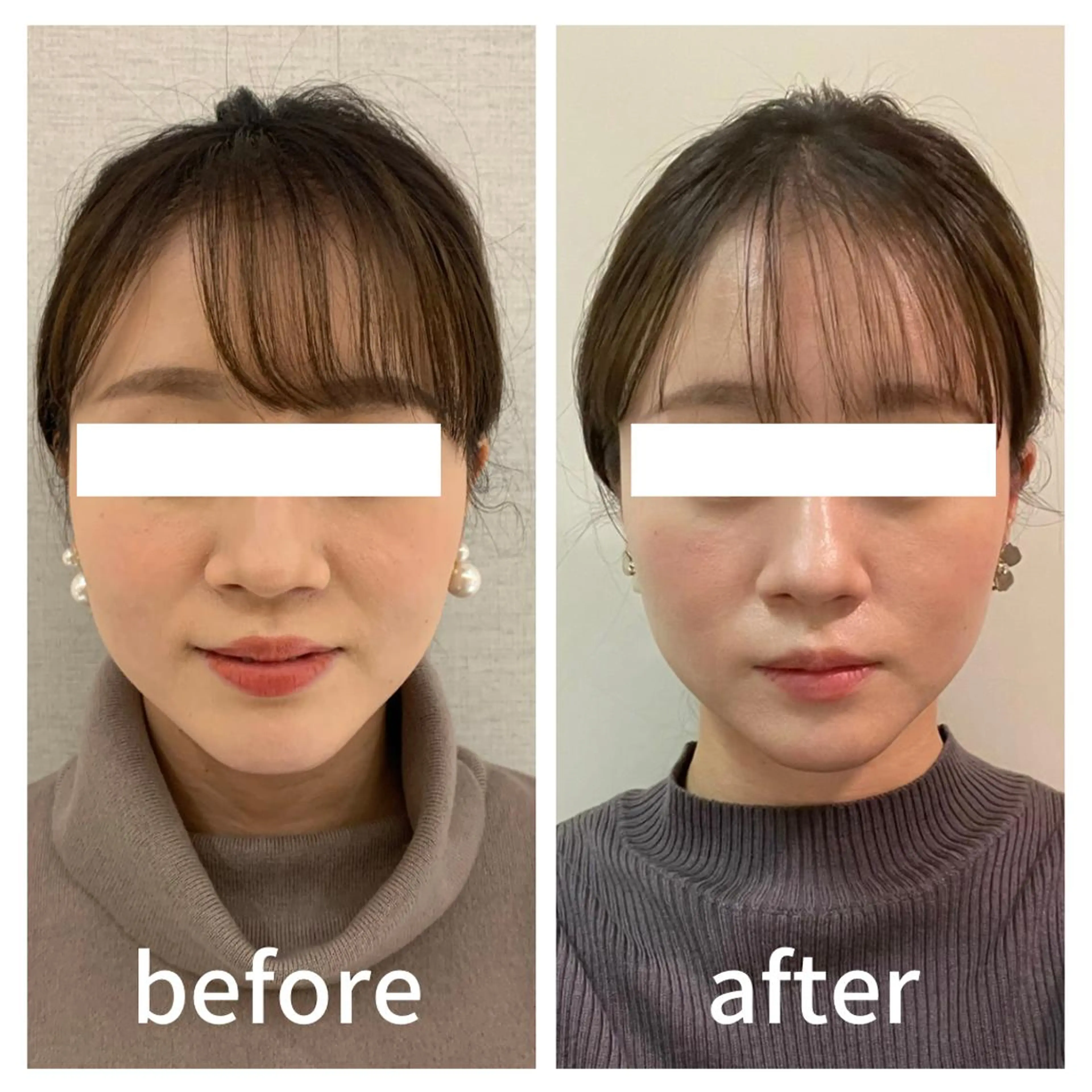🆕痛くない小顔矯正＋ヘッドマッサージの写真