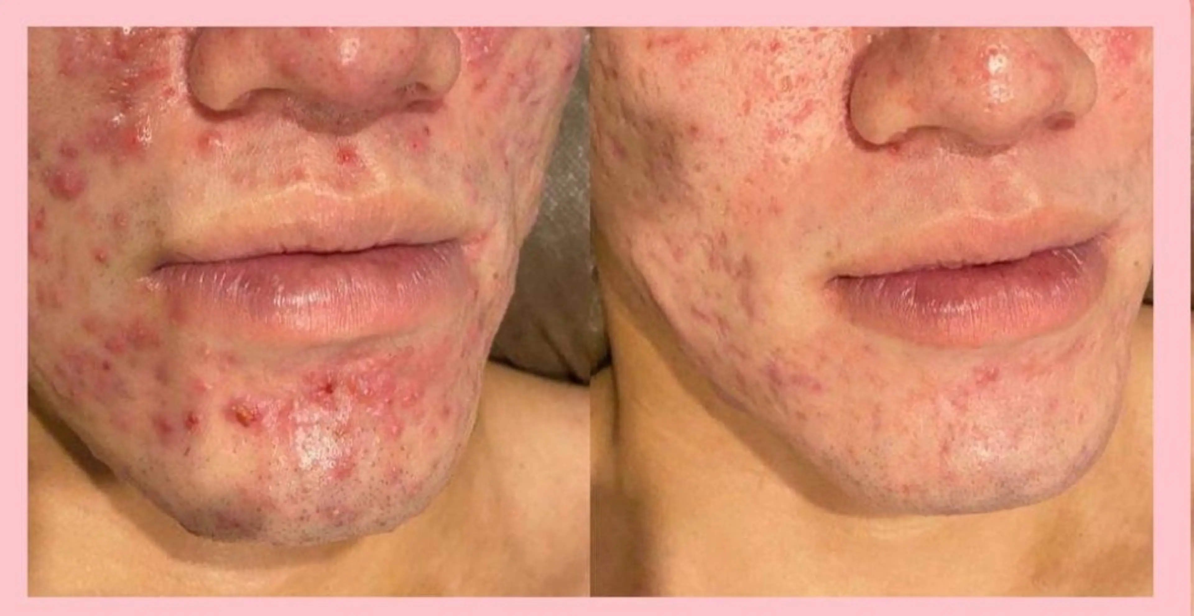 メンズ人気🌿ハーブピーリング強ハード＆角質洗浄＆鼻クレンジング🌿吹き出物、吹き出物跡、毛穴、黒ずみ、脂性肌に👍️の写真