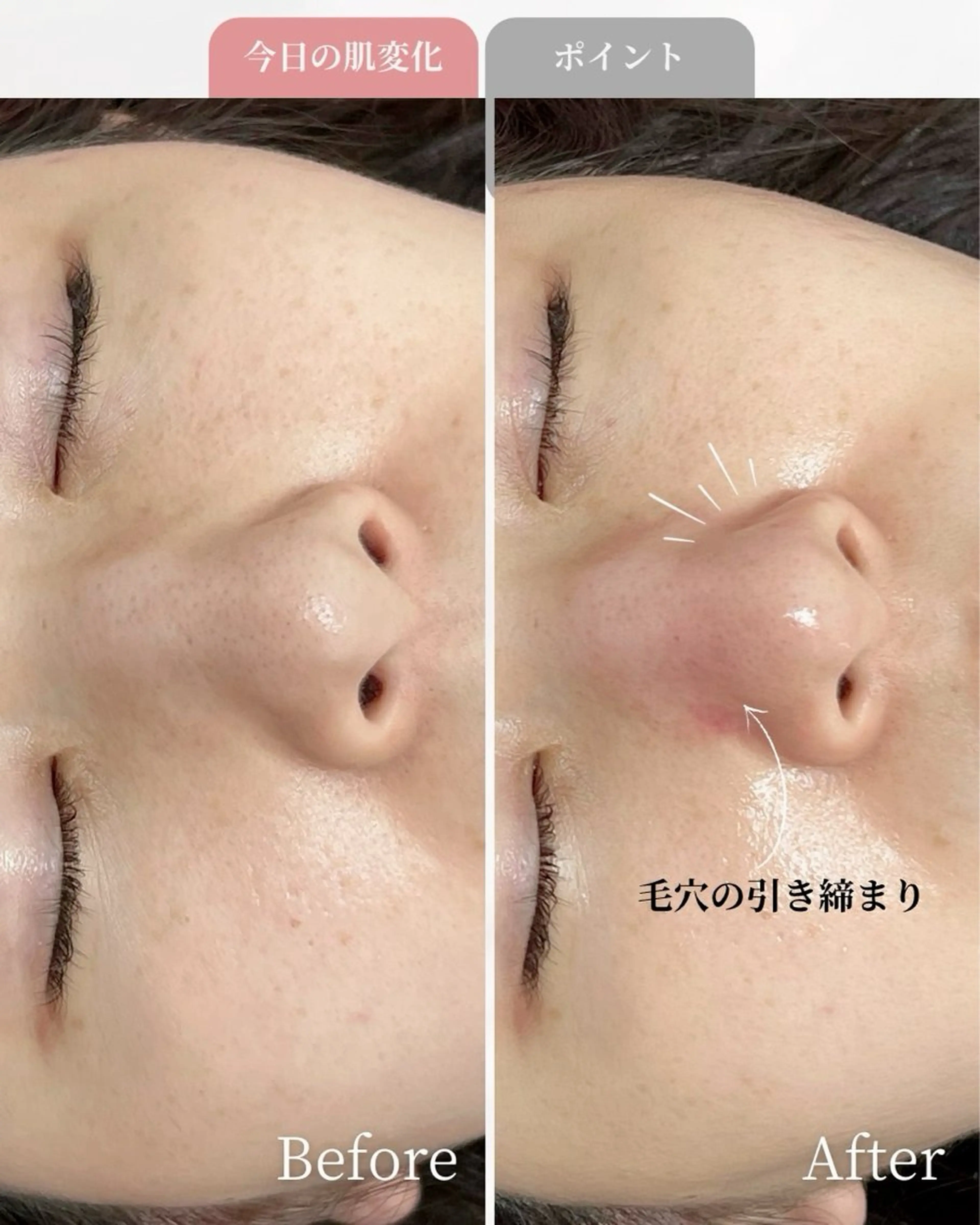 平日限定！NEWオープン特別《毛穴洗浄＋毛穴吸引》気になる鼻の毛穴ごっそりとれる！ザラつき鼻さようなら🌈お試しクーポンの写真