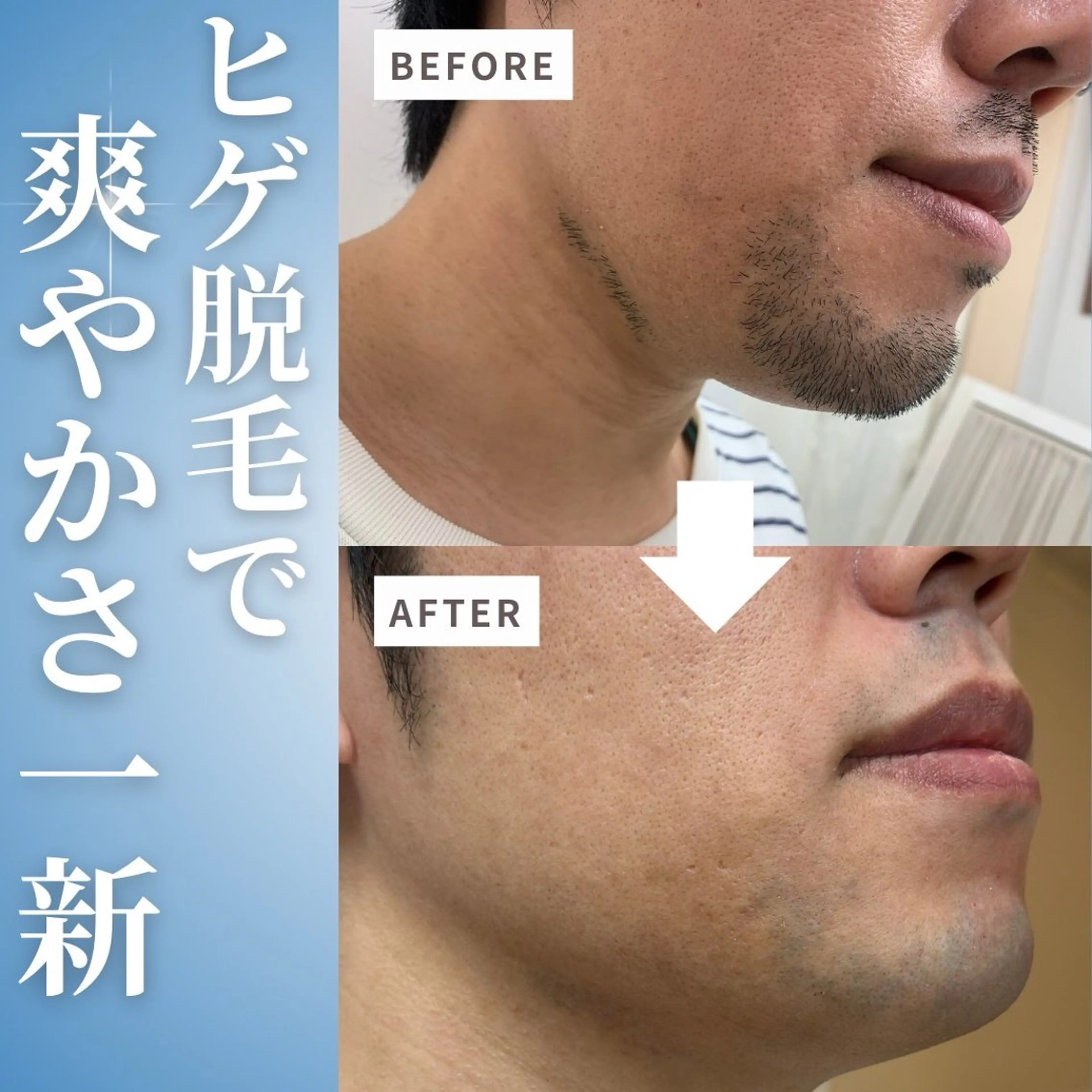 【新規】メンズヒゲ脱毛の写真