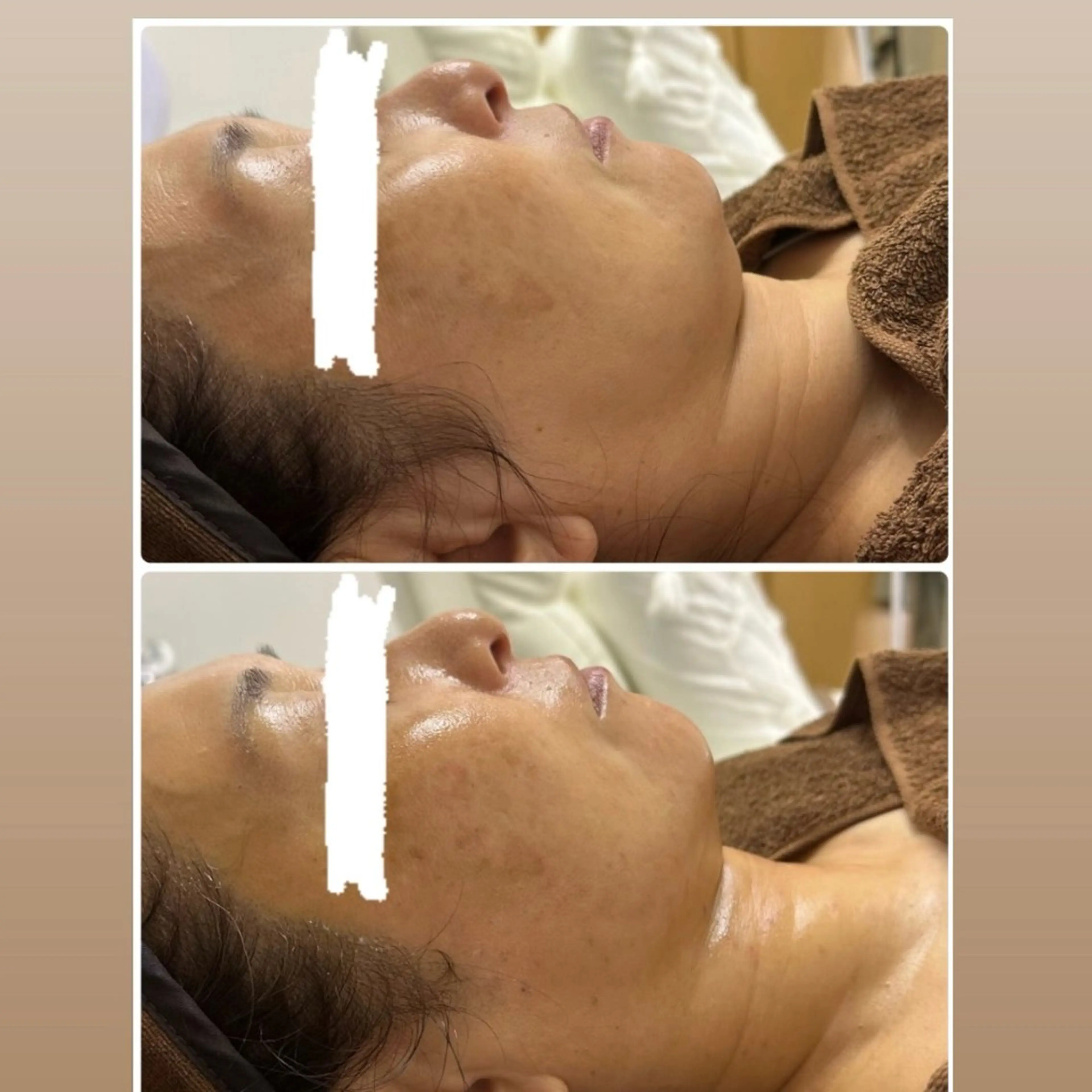 エステ 肌質改善/小顔/ ナスサロ/Yuiのエステ・リラクイメージ