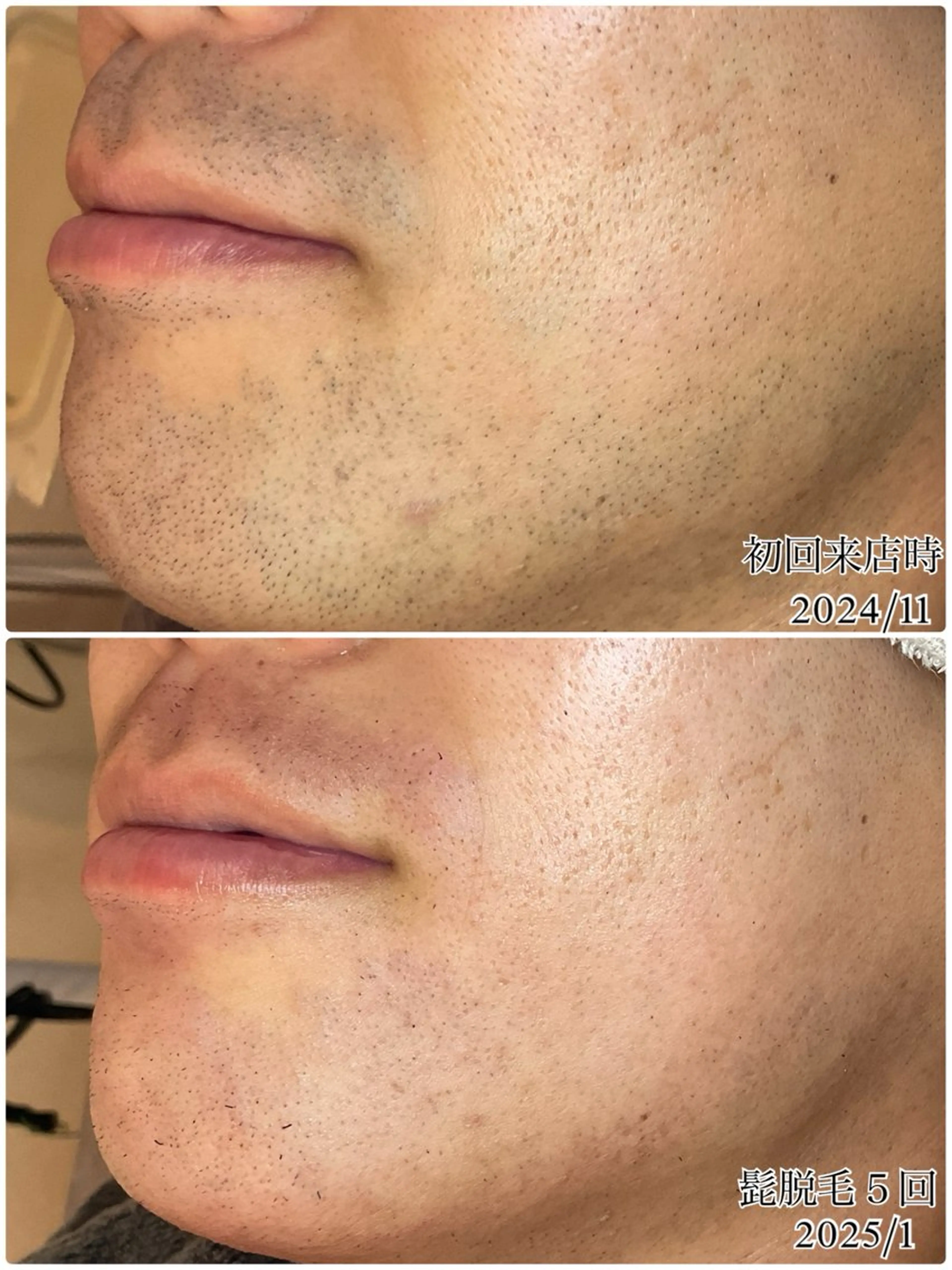 脱毛 ＋belle所属・＋belle／深澤 真緒🩵のエステ・リラクイメージ