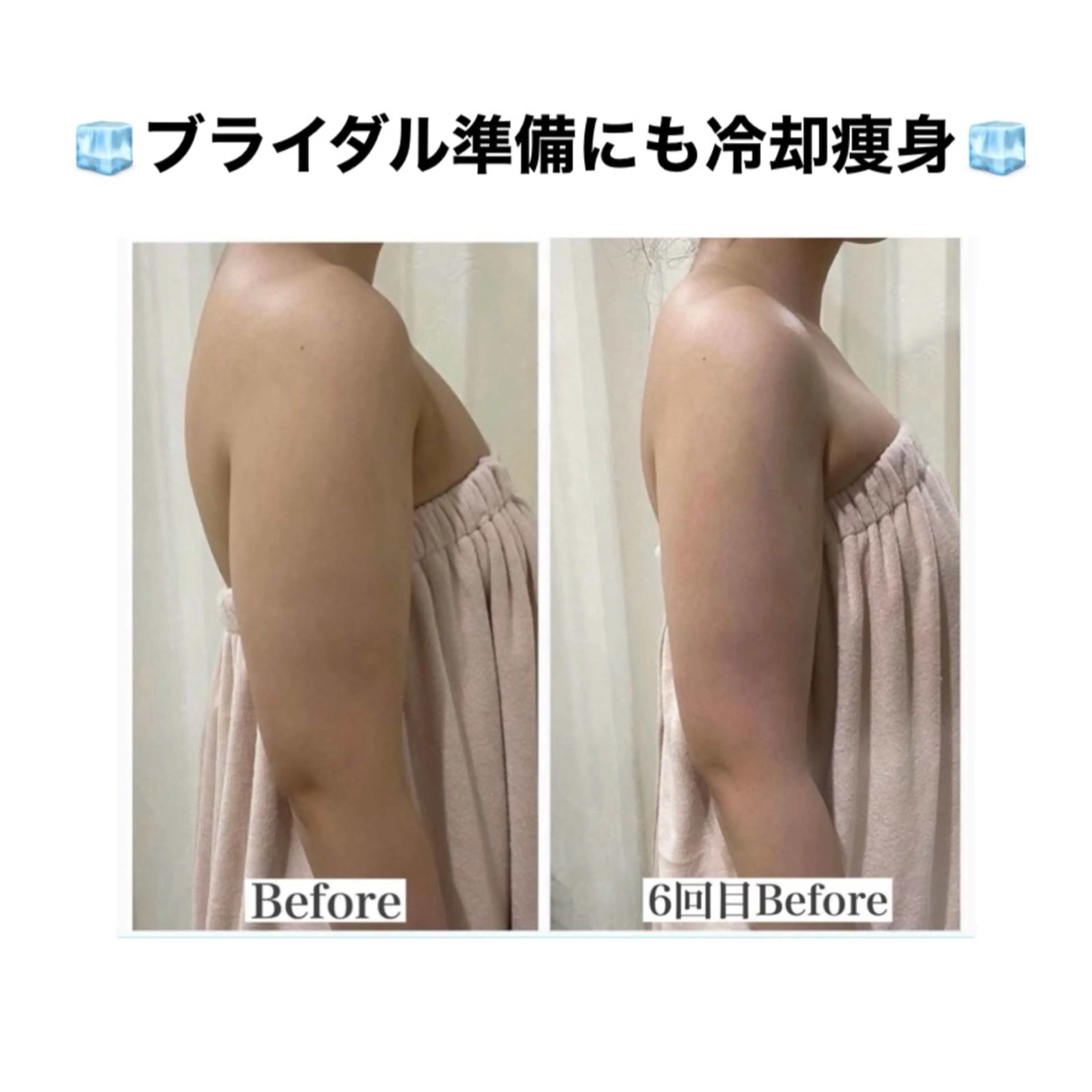【7月限定‼️3名様】二の腕❄️冷却痩身 3回券の写真