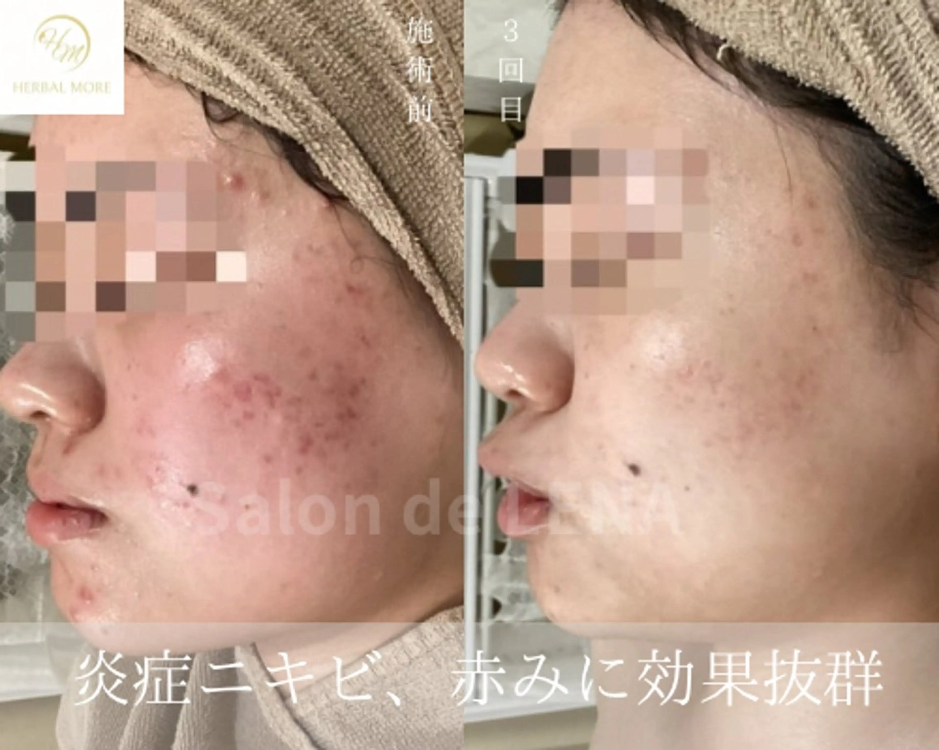回数券購入経験がない方の都度払い/剥けるハーブピーリング顔or体から選択の写真