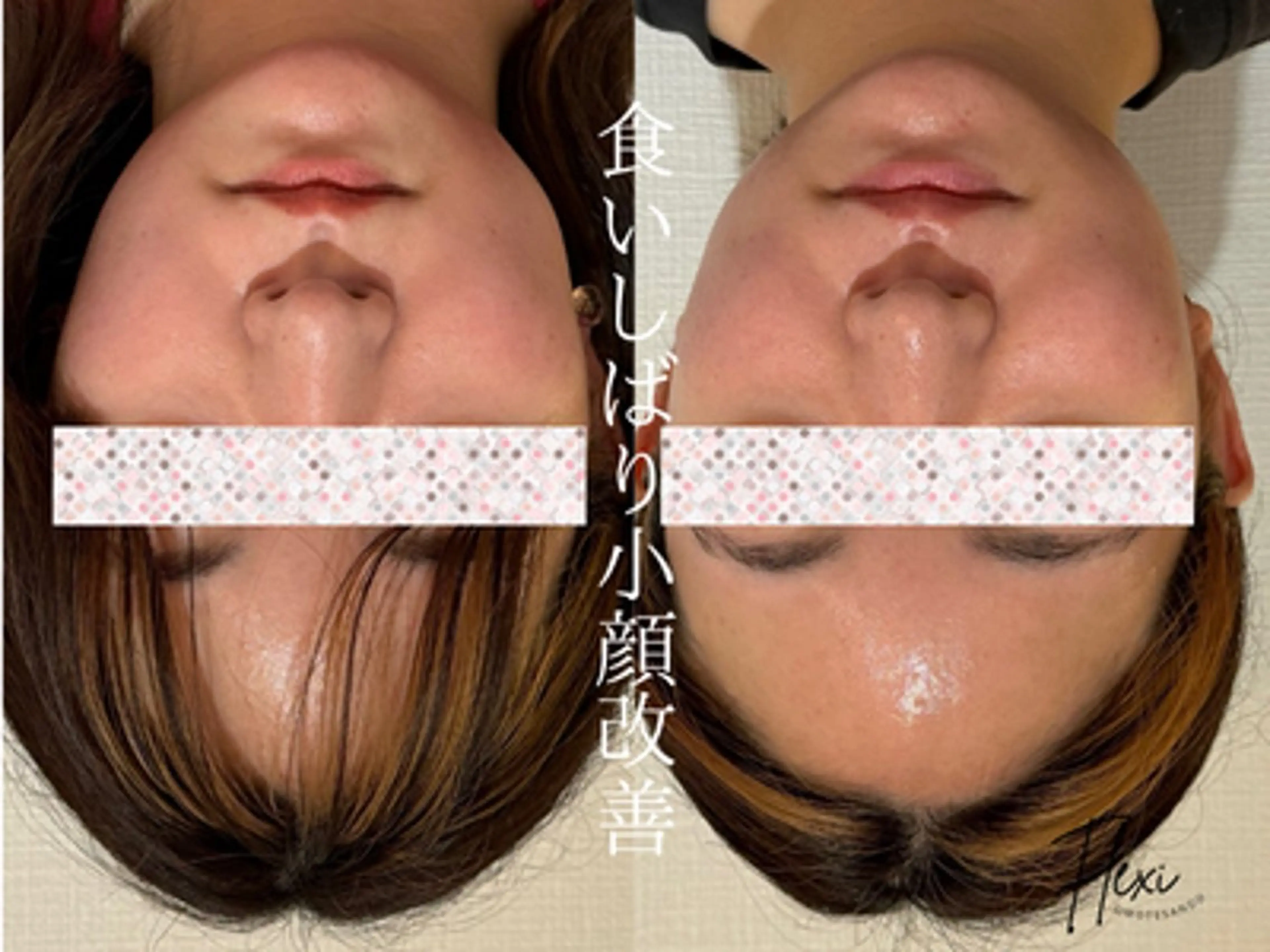 小顔矯正＋美容整体コースの写真