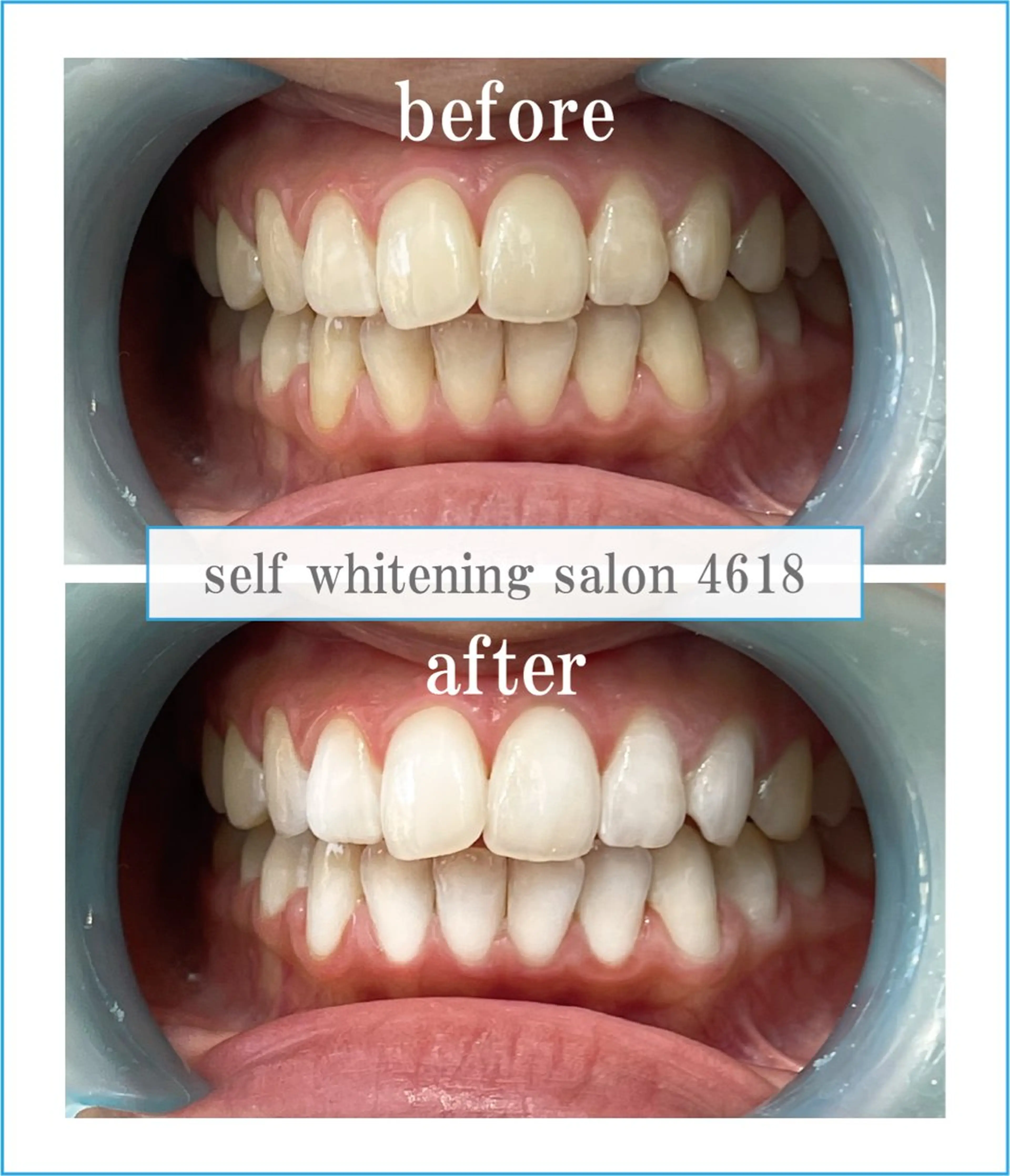 その他 self whitening salon 4618所属・ホワイトニングサロン 4618のその他イメージ