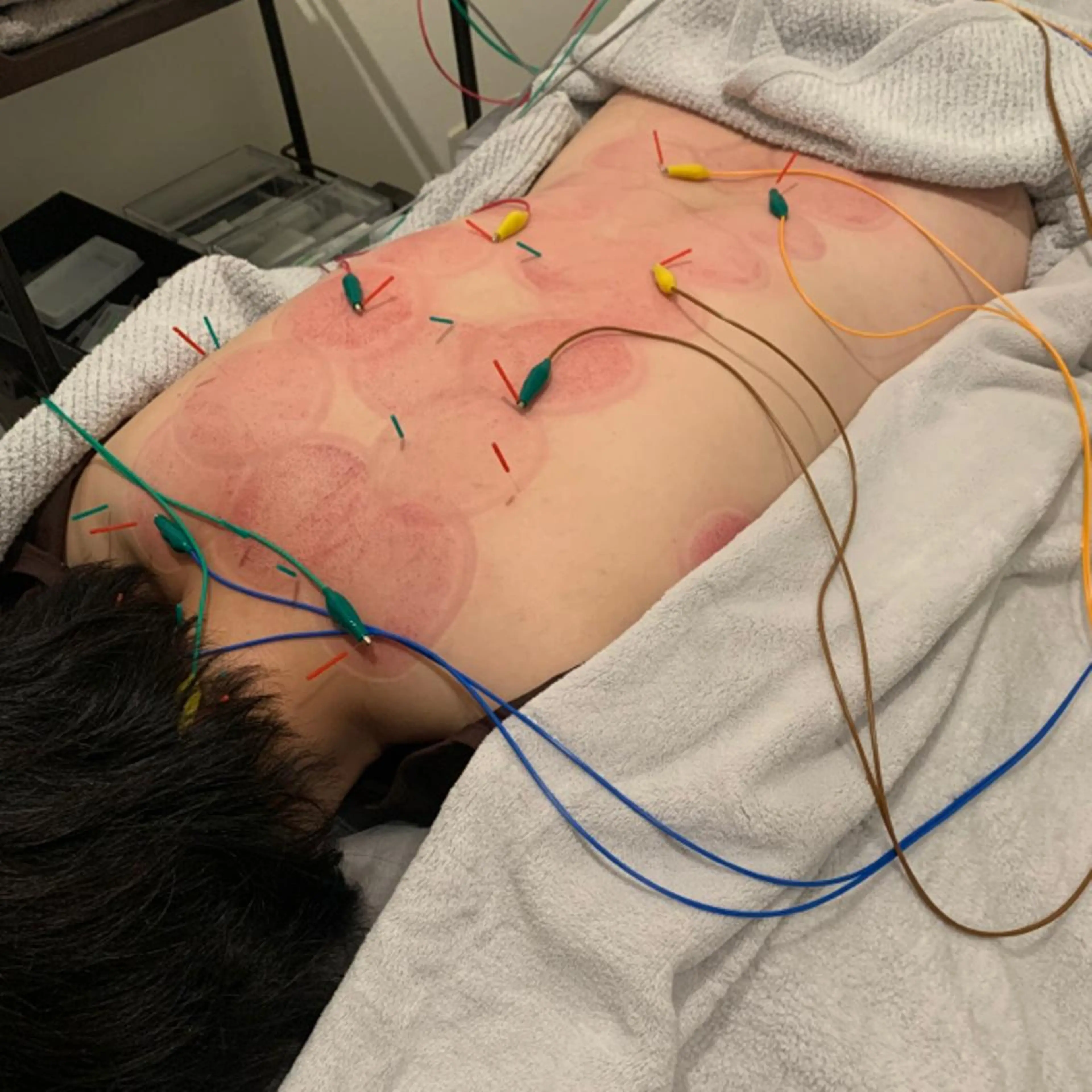 大人気コース✨💆🏼♀️お顔もカラダもしっかりよくばりケア‼️【美容鍼×身体メンテナンス】カッピング付き(約90分)の写真