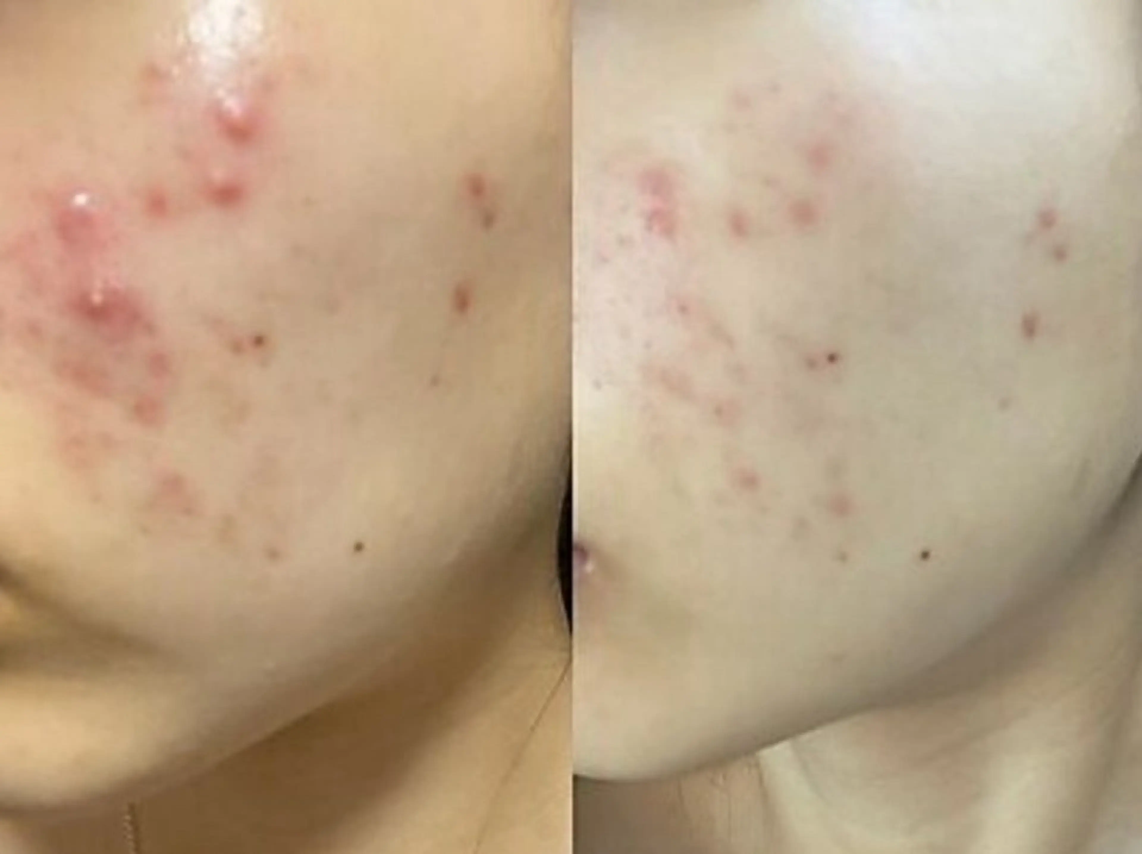 【大人気⭐︎】ハーブピーリング(痛み、剥離、DT無し&当日メイクOK)¥5000の写真